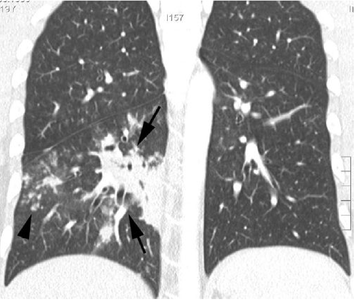 Bronchopneumonia CT - H. influenzae showing right lower lobe patchy consolidation with tree-in-bud