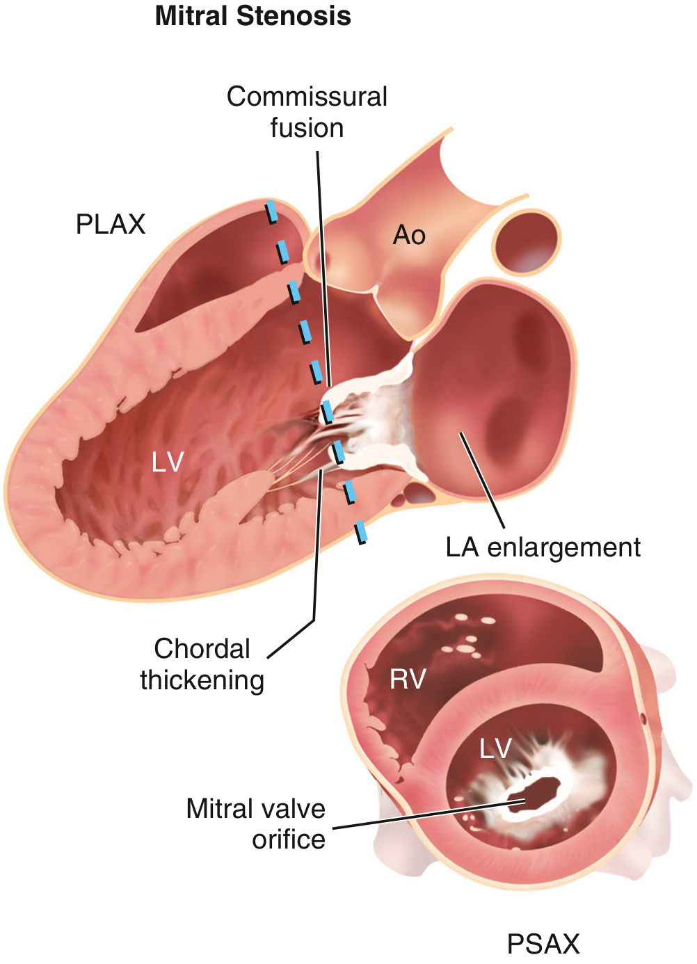 2D echo findings in mitral stenosis: PLAX showing commissural fusion, diastolic doming, chordal thickening, and LA enlargement; PSAX showing the restricted mitral valve orifice