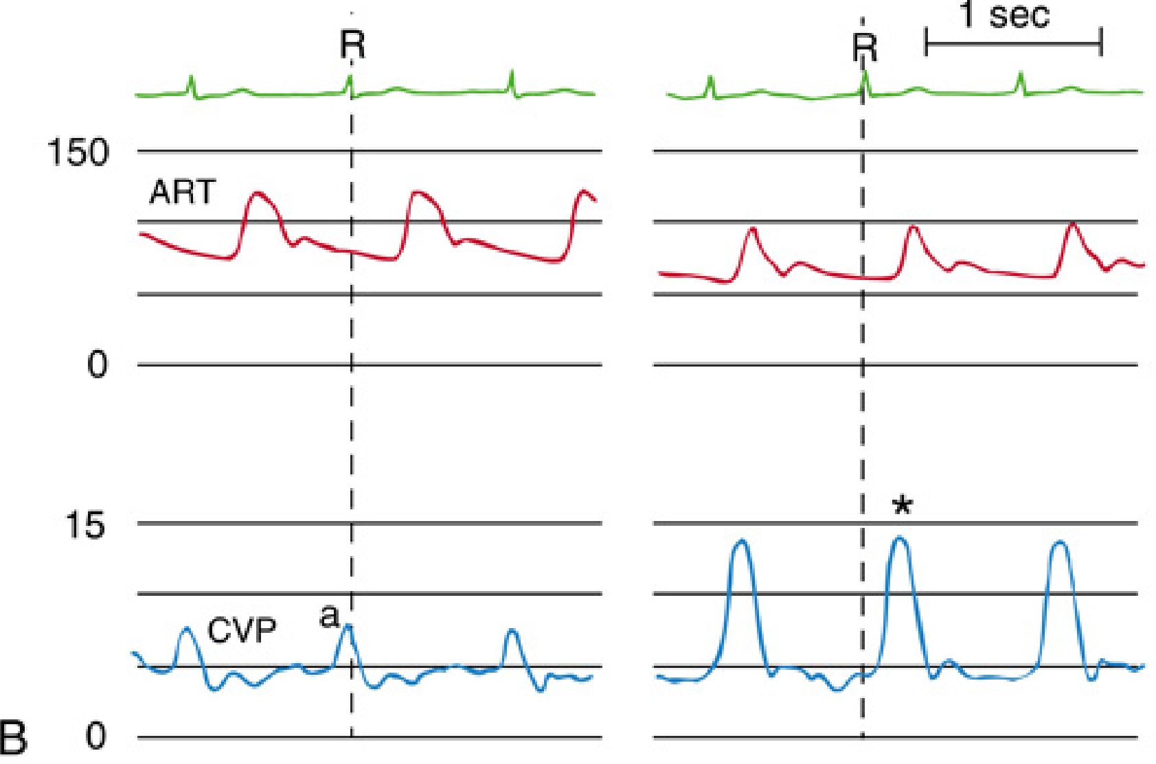 AV dissociation CVP showing normal a wave on left vs giant cannon a waves on right