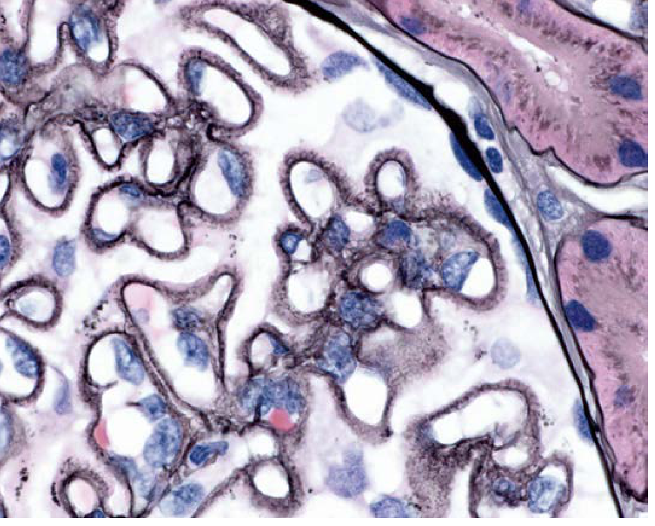 LN Class V - Membranous thickening, H&E