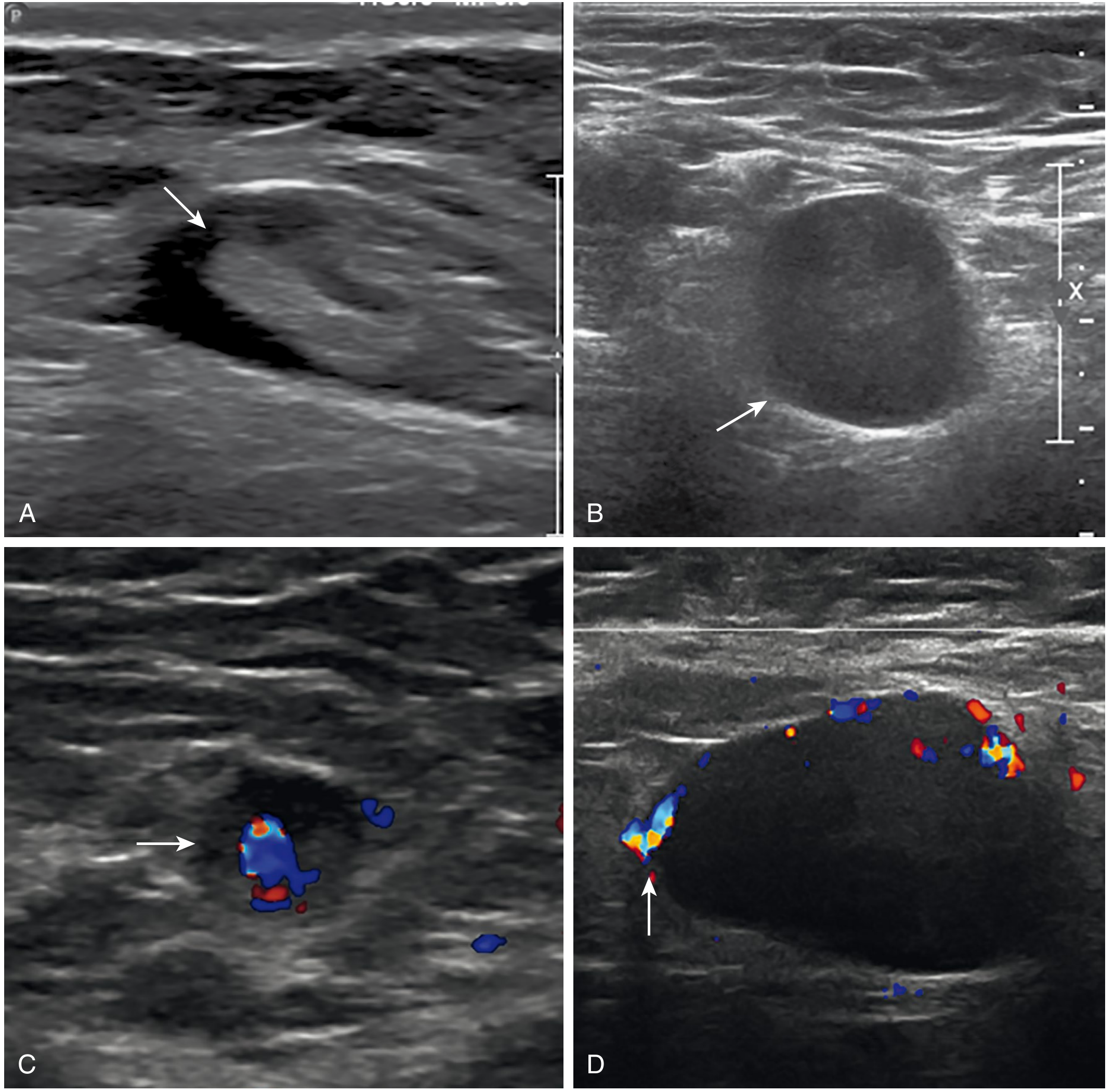 Benign vs malignant lymph node ultrasound - B-mode and Doppler