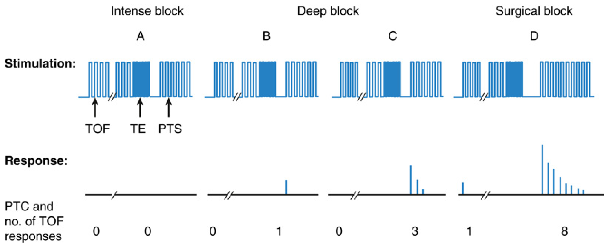 PTC at 4 depths of block: intense (PTC=0, TOF=0), deep (PTC=1, TOF=0), less deep (PTC=3, TOF=0), surgical (PTC=8, TOF=1)