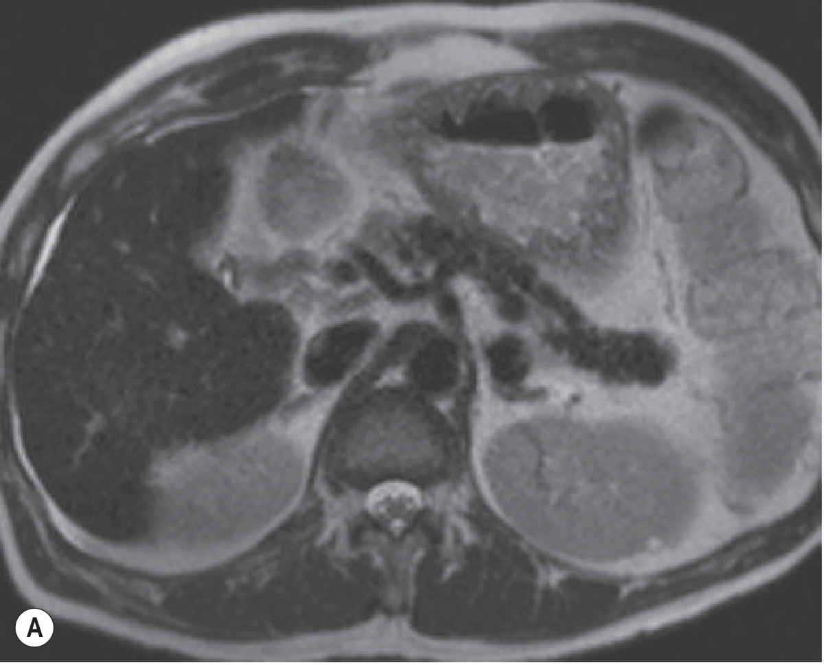 Haemochromatosis-related cirrhosis on MRI - T2W showing shrunken nodular liver with abnormally low signal parenchyma compared to adjacent muscle (A), even better appreciated on in-phase gradient-echo T1W image (B). Note severe pancreatic iron overload which is pathognomonic.