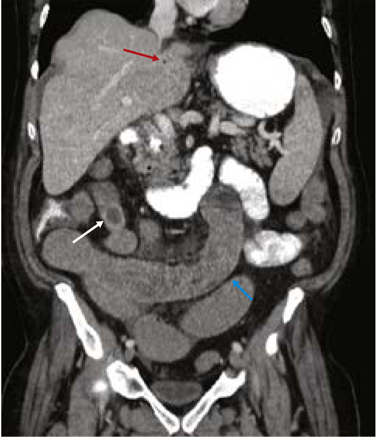 CT coronal image of Rigler's triad - pneumobilia (red arrow), dilated small bowel (blue arrow), ectopic obstructing gallstone (white arrow)