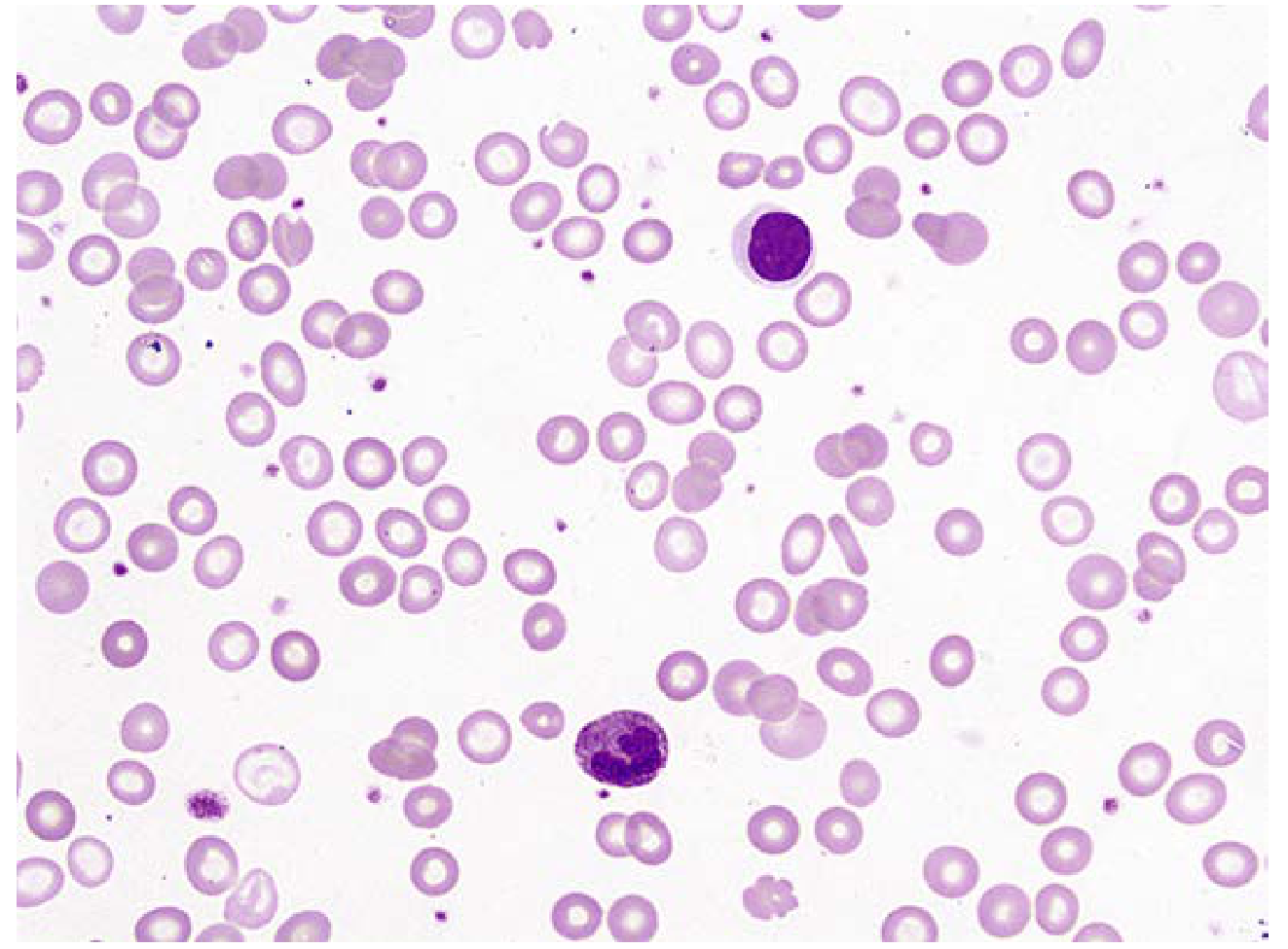 Microcytic hypochromic red cells in iron deficiency anemia - large central pallor, narrow rim of peripheral haemoglobin