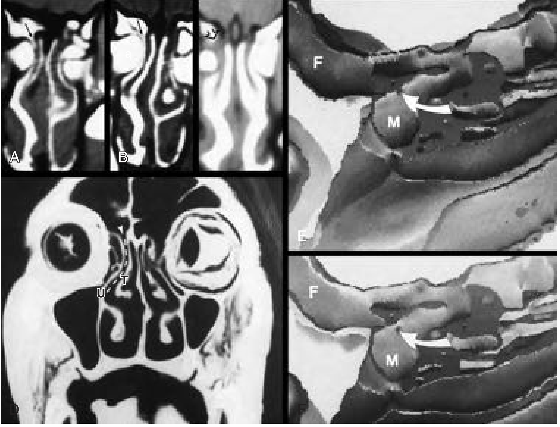 Coronal CT of paranasal sinuses showing frontal recess, agger nasi, uncinate process and middle meatus - Cummings Otolaryngology Fig. 38.4