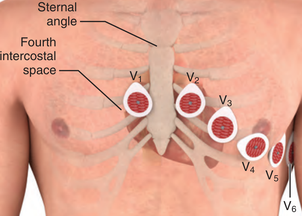 Precordial lead placement V1-V6 on chest