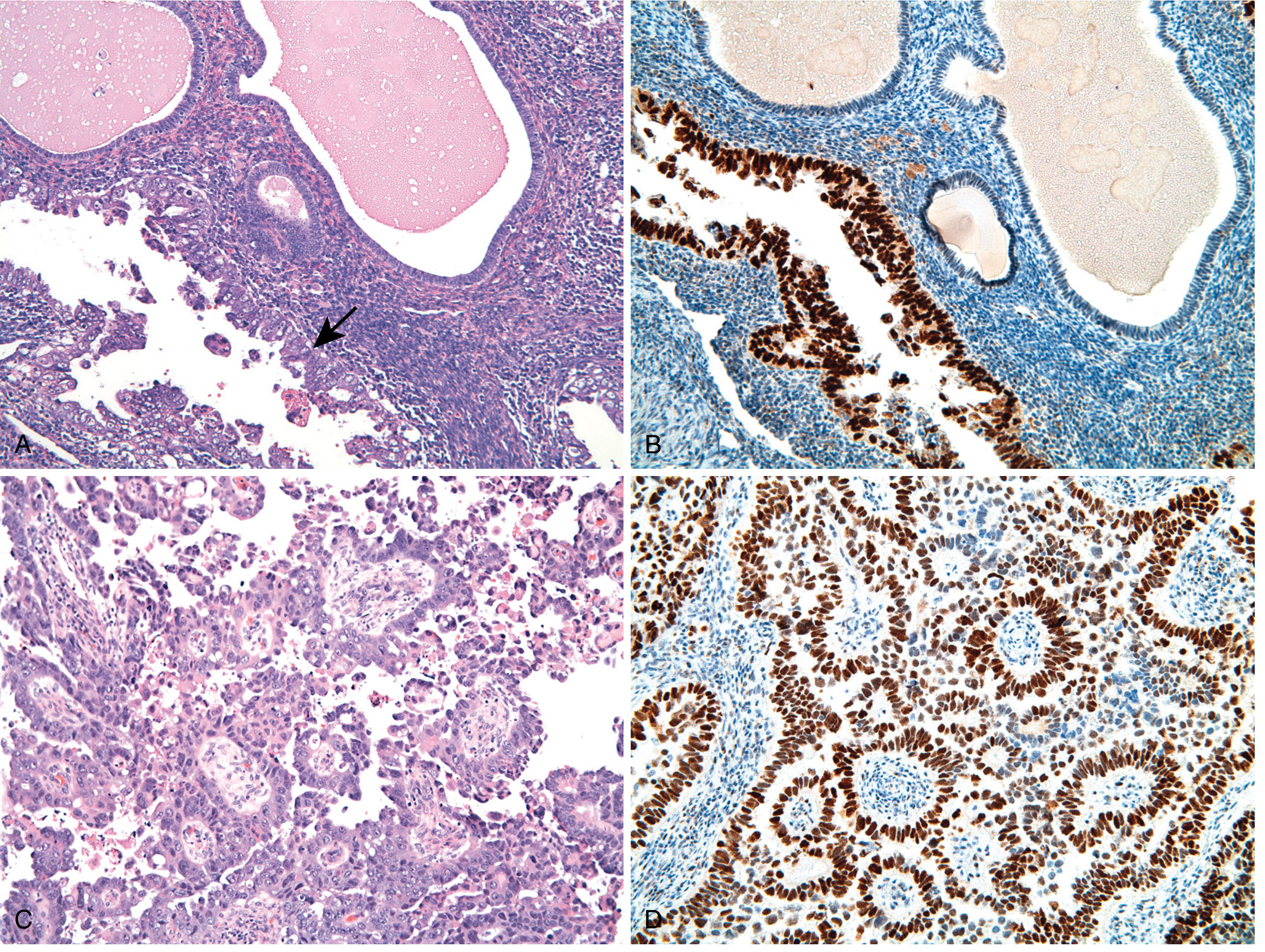Serous endometrial carcinoma and EIC