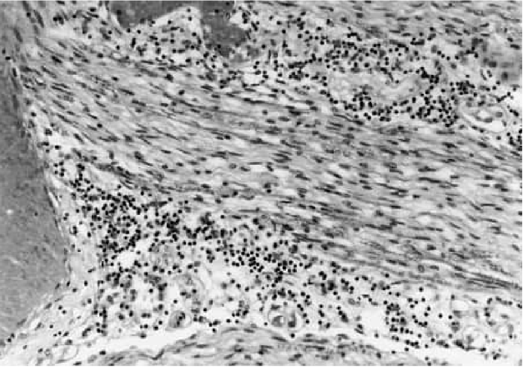 Histopathology of cauda equina in GBS showing dense mononuclear infiltrate around nerve roots (H&E stain)