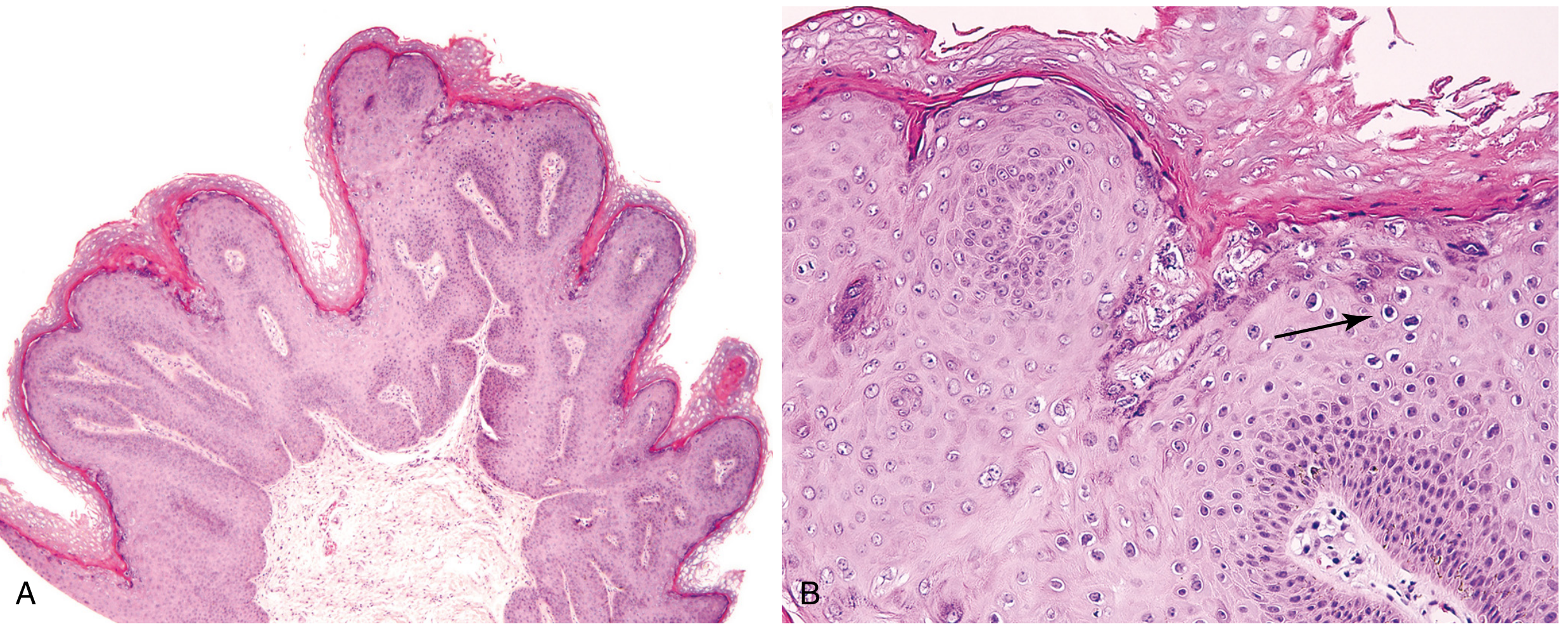 Condyloma acuminatum: (A) low-power shows exophytic papillary architecture; (B) high-power shows koilocytic atypia - atypical hyperchromatic nuclei with perinuclear halos (arrow), pathognomonic of HPV