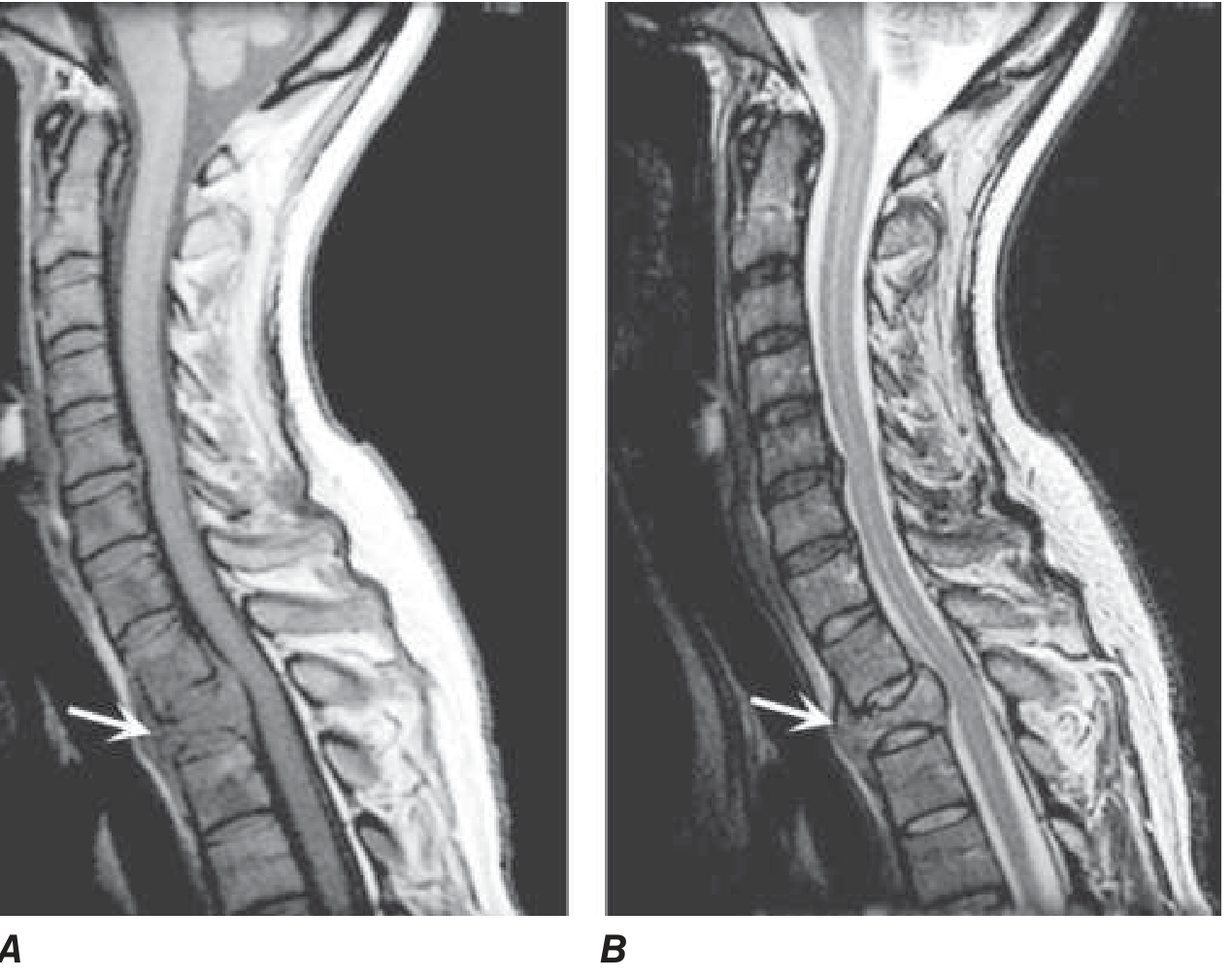 MRI showing epidural spinal cord compression from vertebral metastasis - T1 shows low signal collapsed vertebra with cord displacement