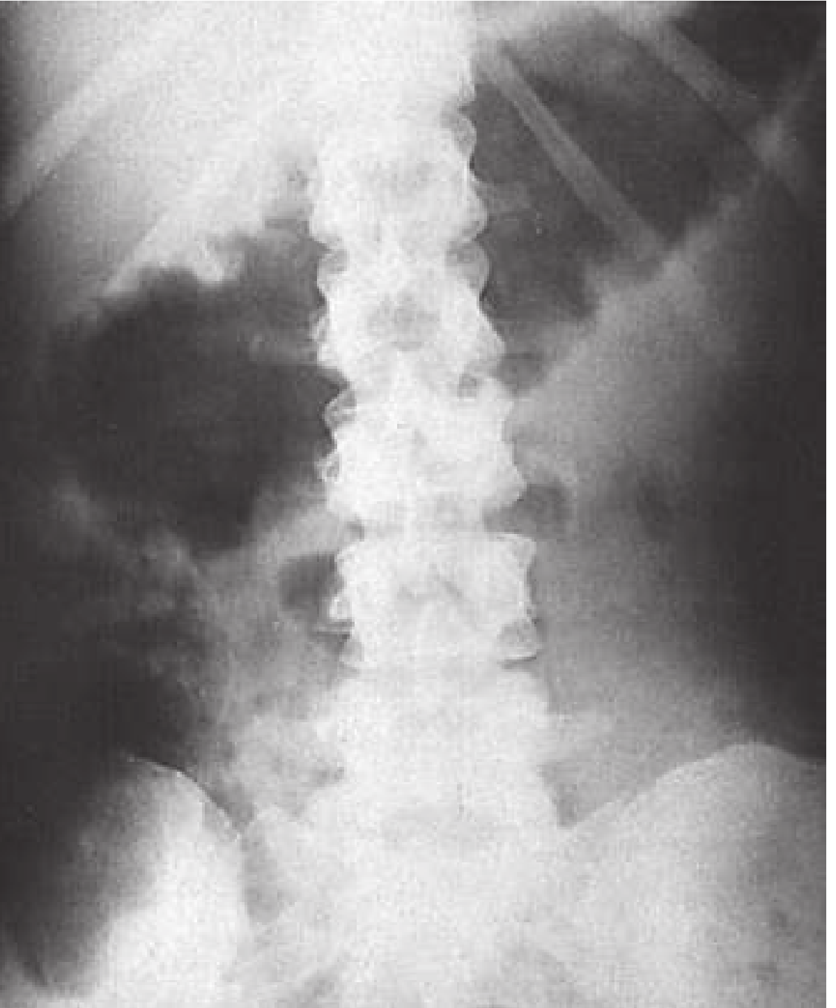 Toxic Megacolon