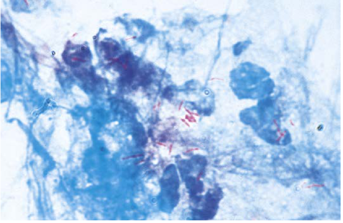 AFB stain - Red acid-fast bacilli (TB) against blue background (Kinyoun, 400x)