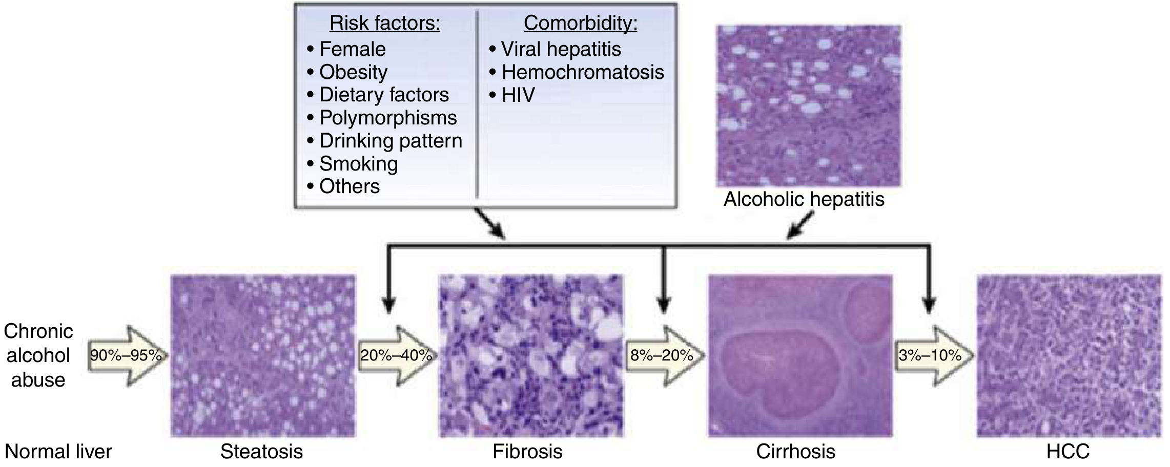 Progression of alcoholic-related liver disease with risk factors, comorbidities, histological images, and prevalence percentages at each stage from steatosis to HCC