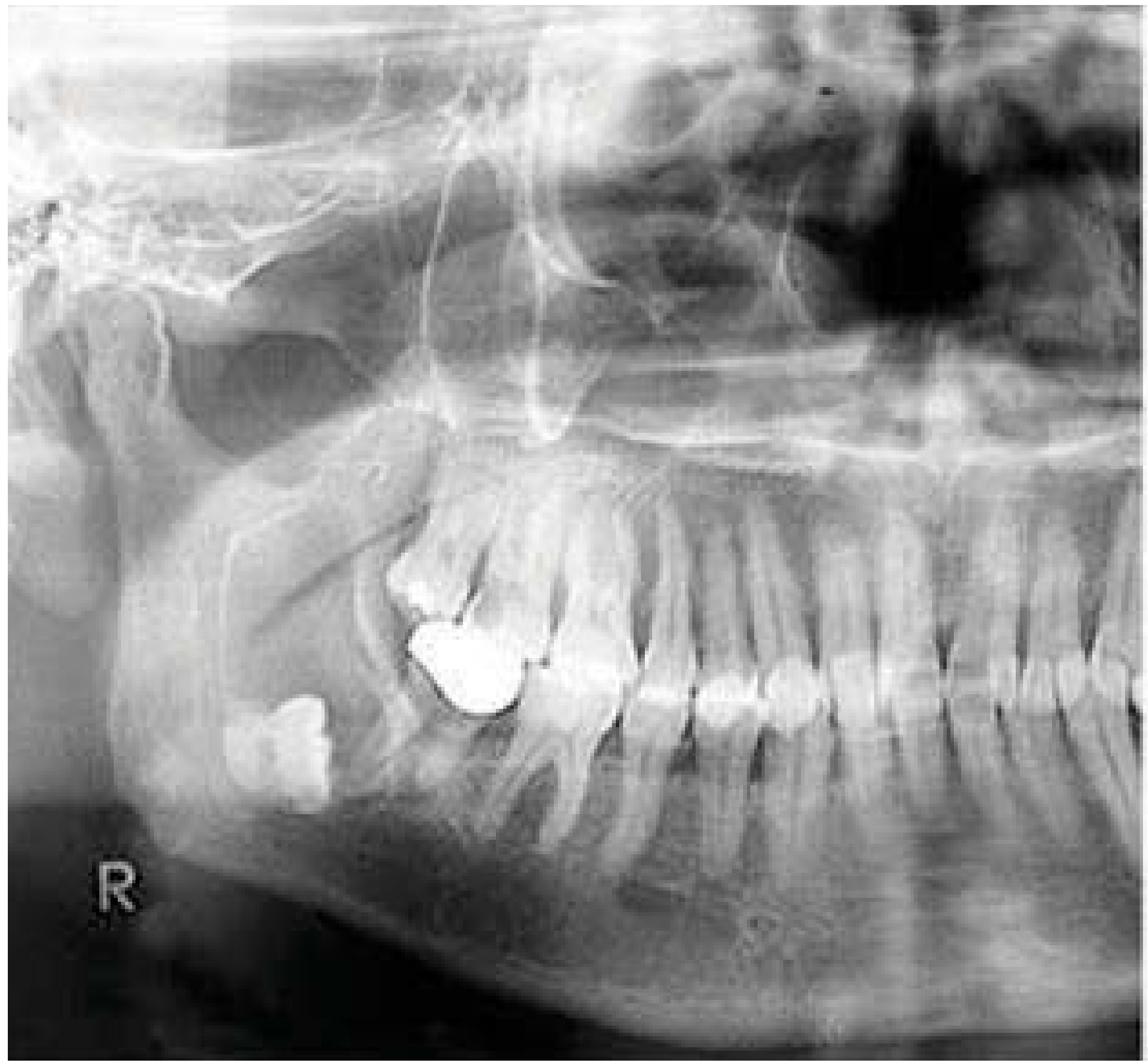 Bilateral dentigerous cysts seen radiologically - OPG showing radiolucent lesion around crown of lower molar