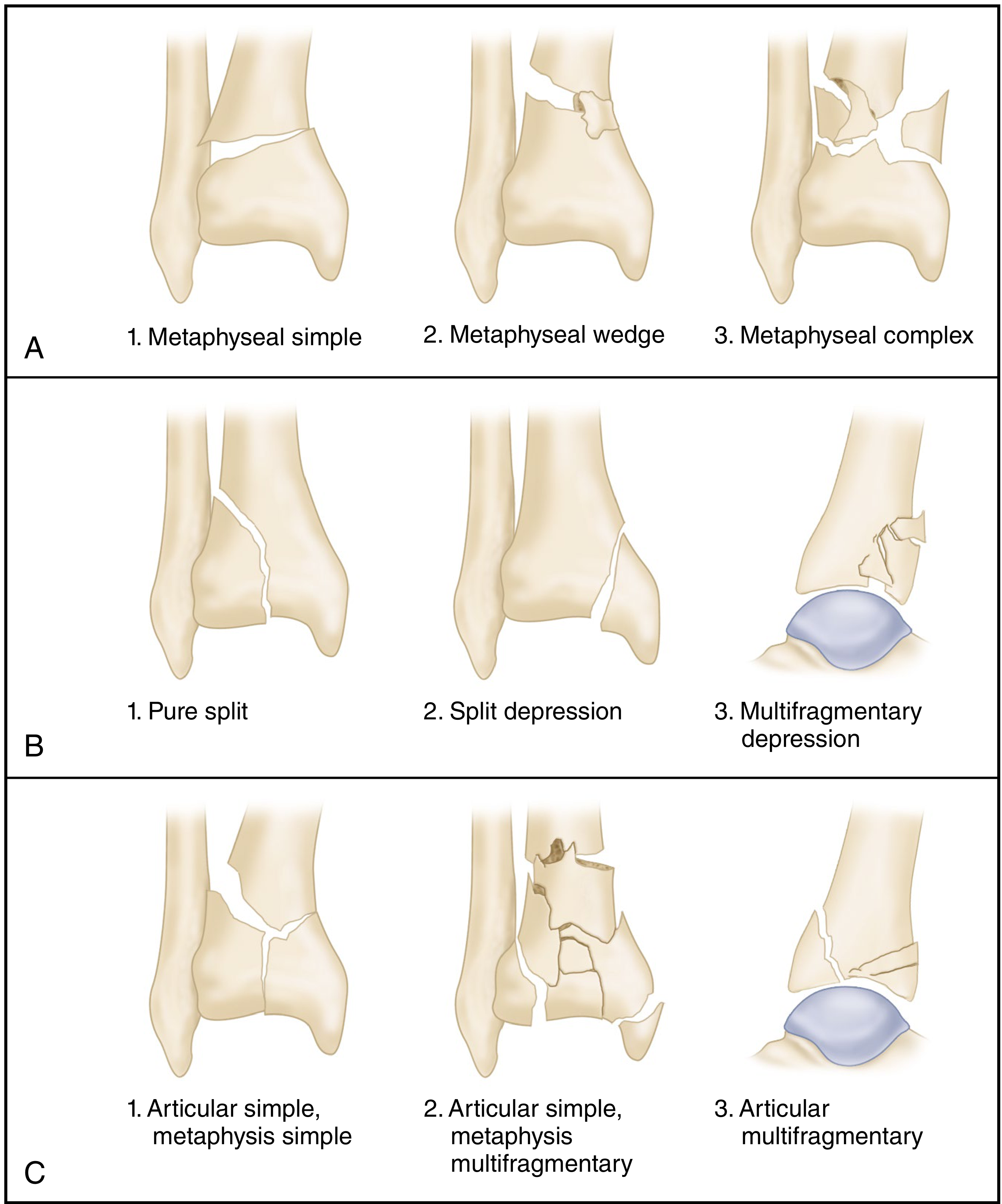 AO/OTA Classification — Type A (extraarticular), Type B (partial articular), Type C (complete articular) with subtypes