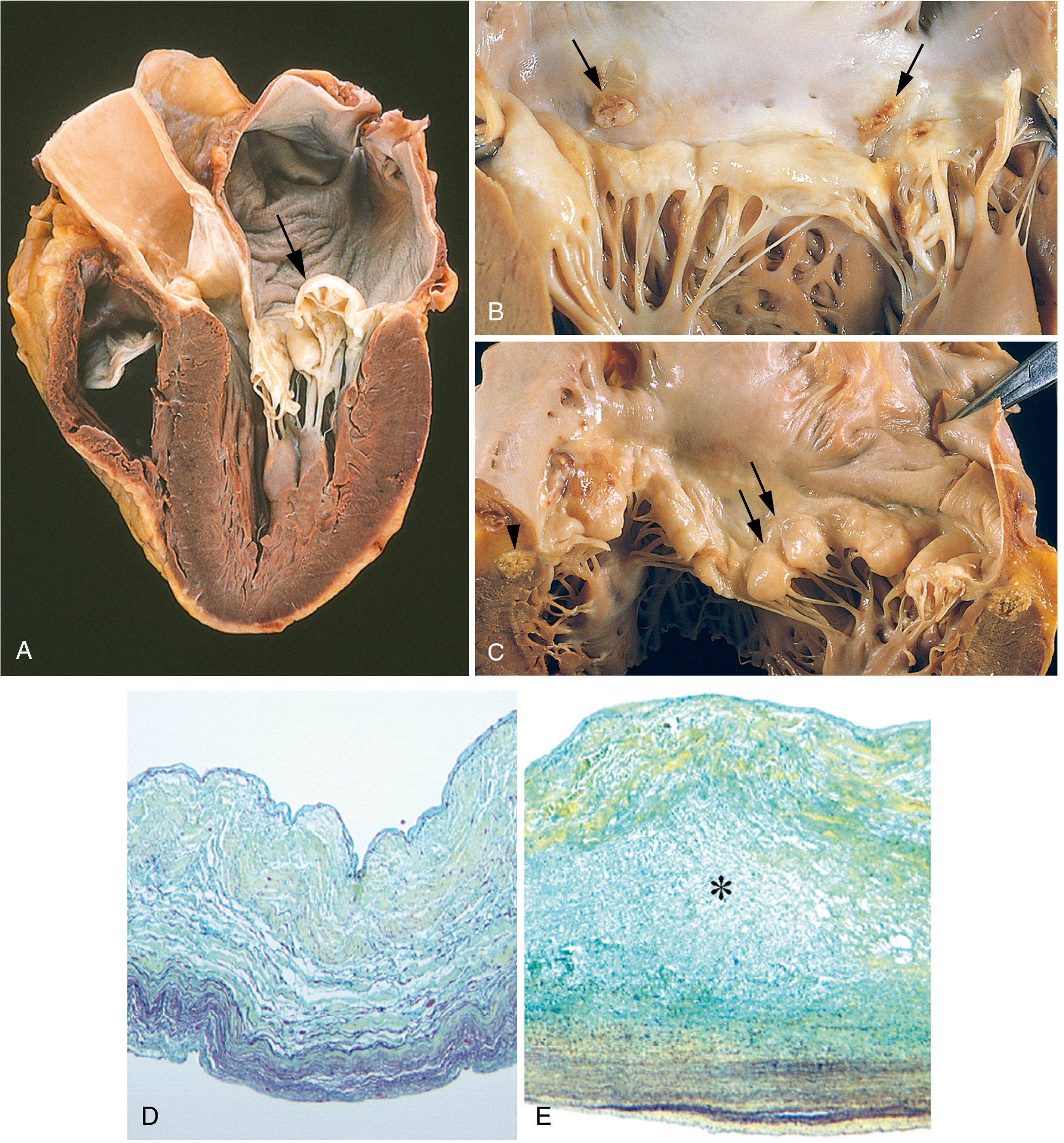 MVP: A=prolapsing posterior leaflet, B=billowing posterior leaflet with thrombotic plaques, C=hooding with annular calcification; D=normal valve histology; E=myxomatous valve with expanded spongiosa (asterisk)