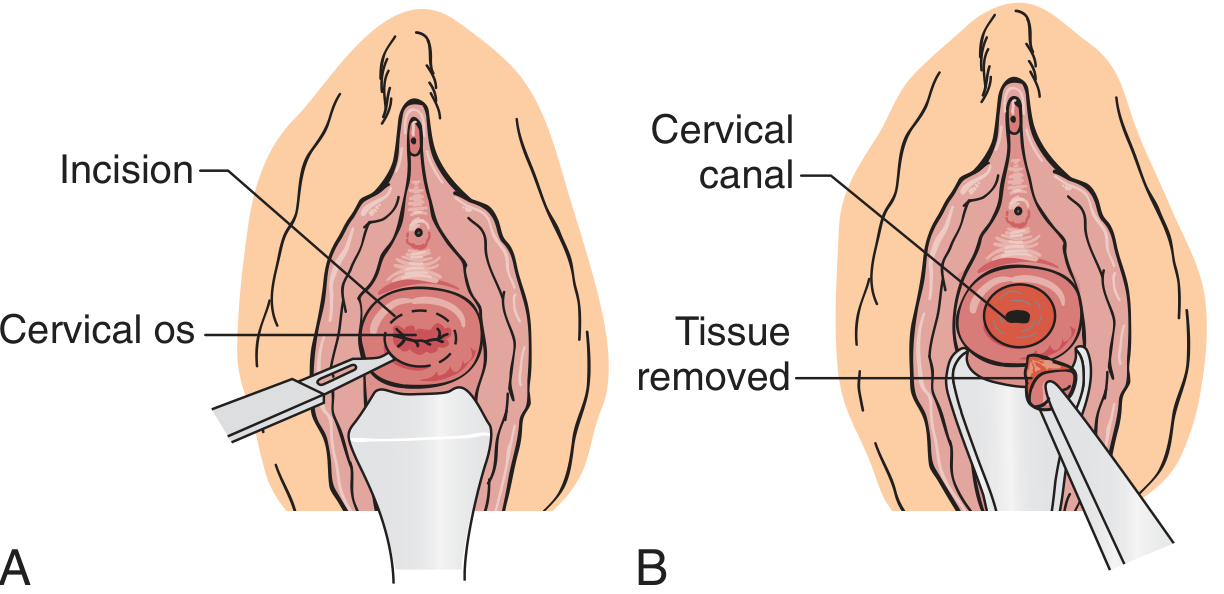 Conization technique: A = circumferential incision at cervical os; B = removal of cone-shaped tissue specimen