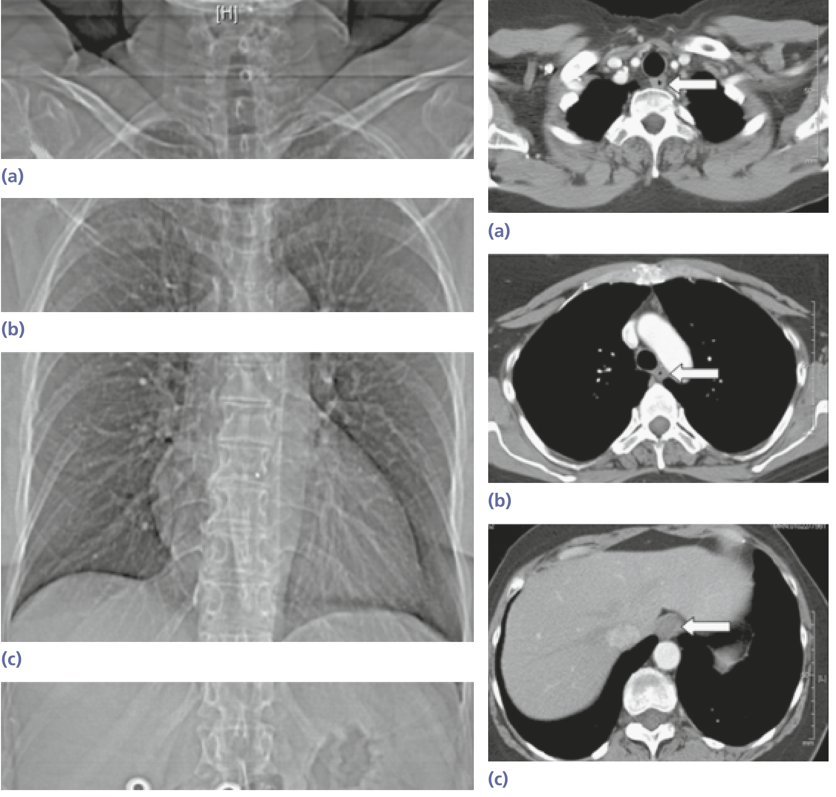 CT cross-sections of the esophagus at cervical, thoracic (near aortic arch), and abdominal levels showing its anatomical relations