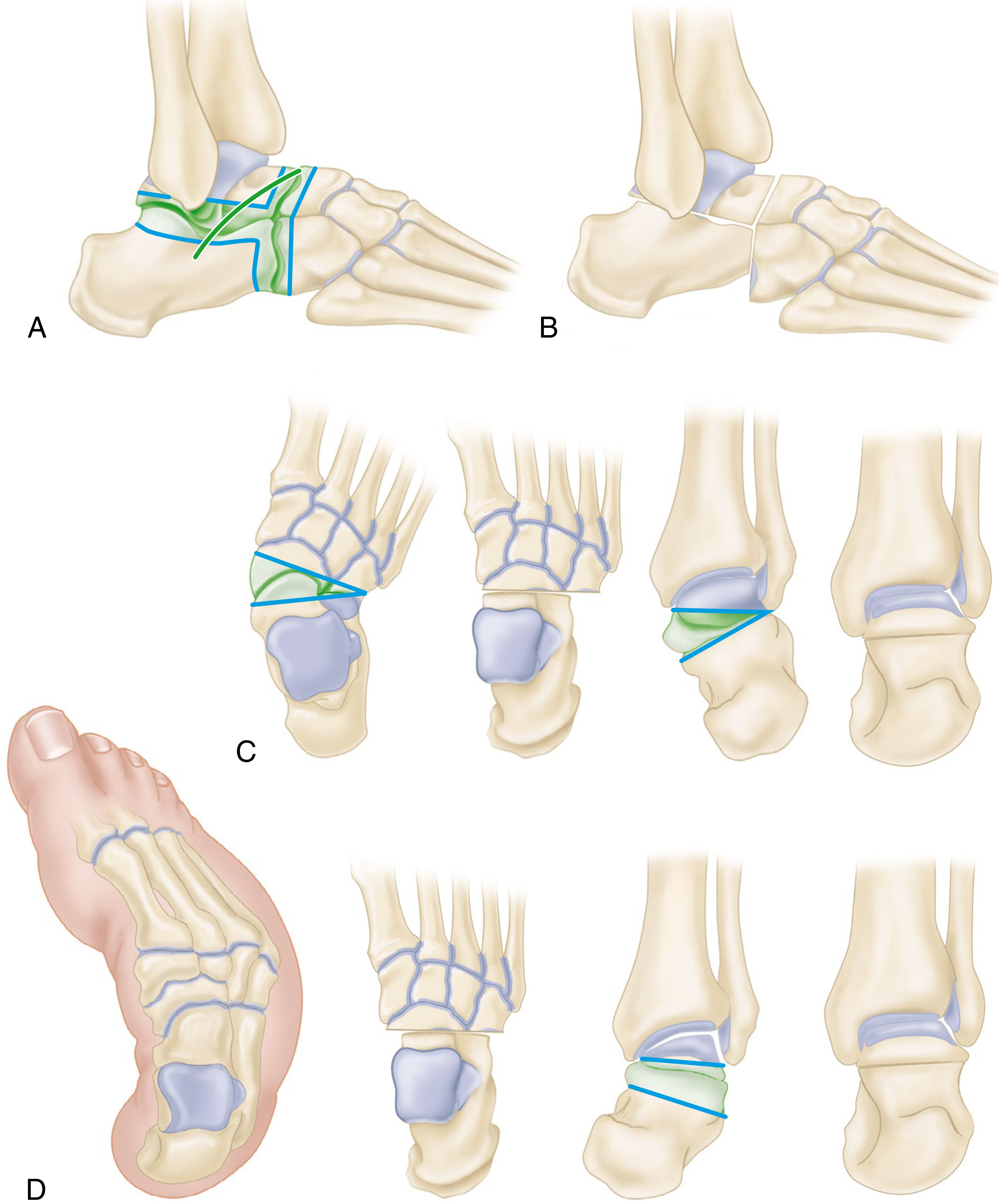 Triple arthrodesis - incisions and wedge resections (Campbell's Operative Orthopaedics 15th Ed)