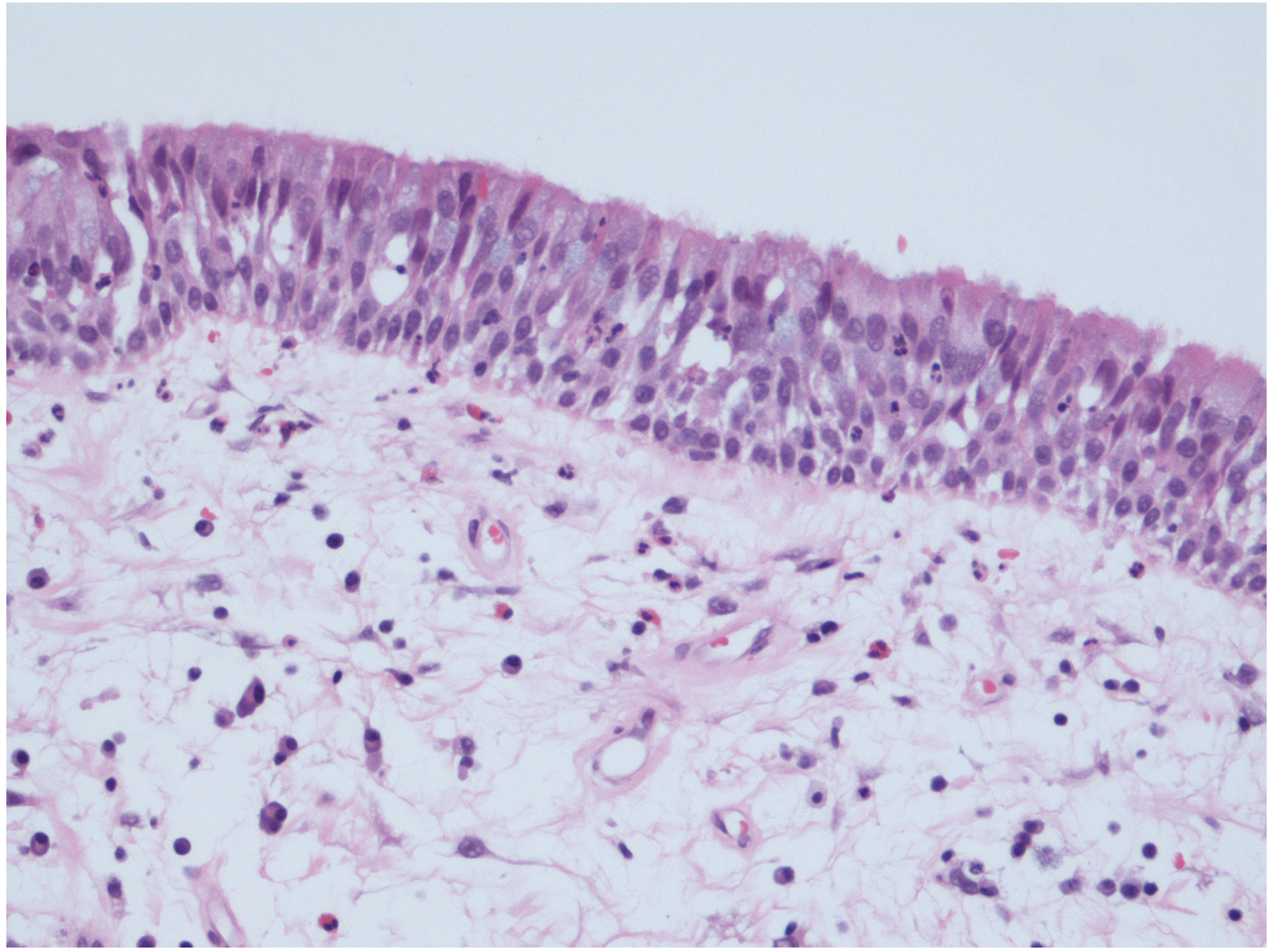 Histopathology of nasal polyp - H&E stain showing pseudostratified ciliated epithelium over oedematous stroma with scattered inflammatory cells (Figure 95.2 - Scott-Brown's)