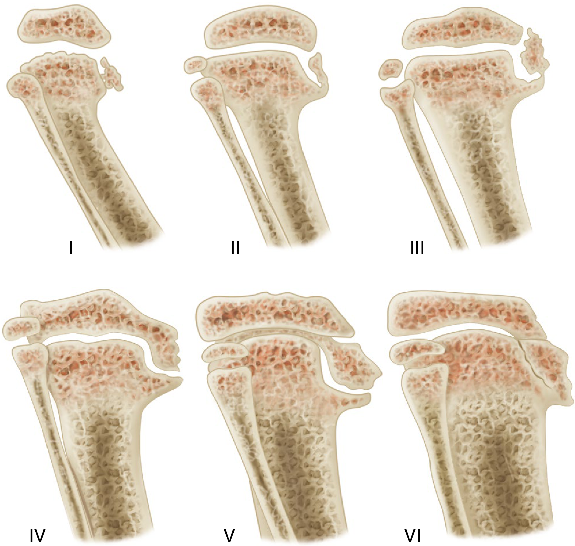 Langenskiöld stages I through VI of infantile tibia vara