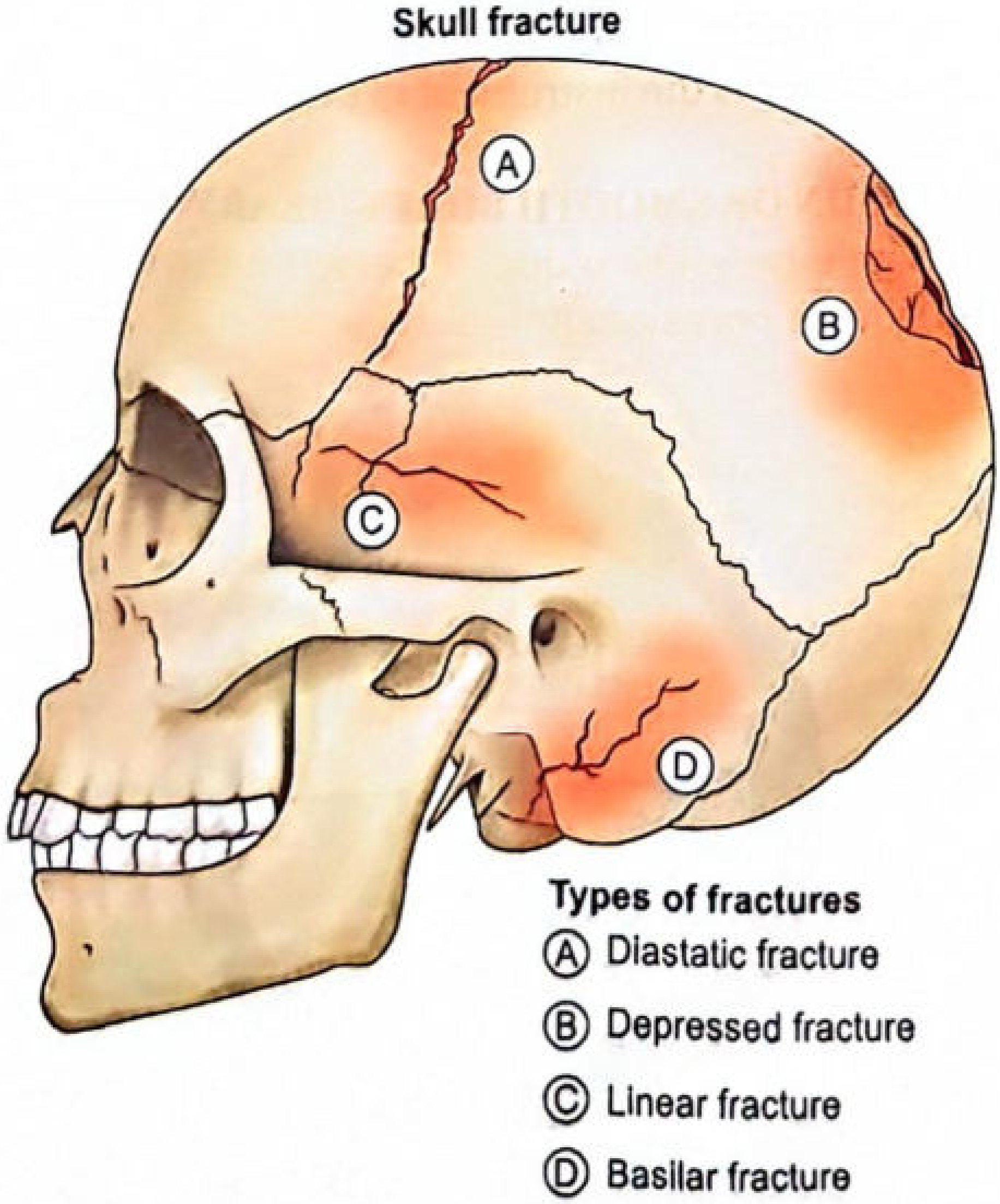 Types of skull fractures - Diastatic, Depressed, Linear, Basilar