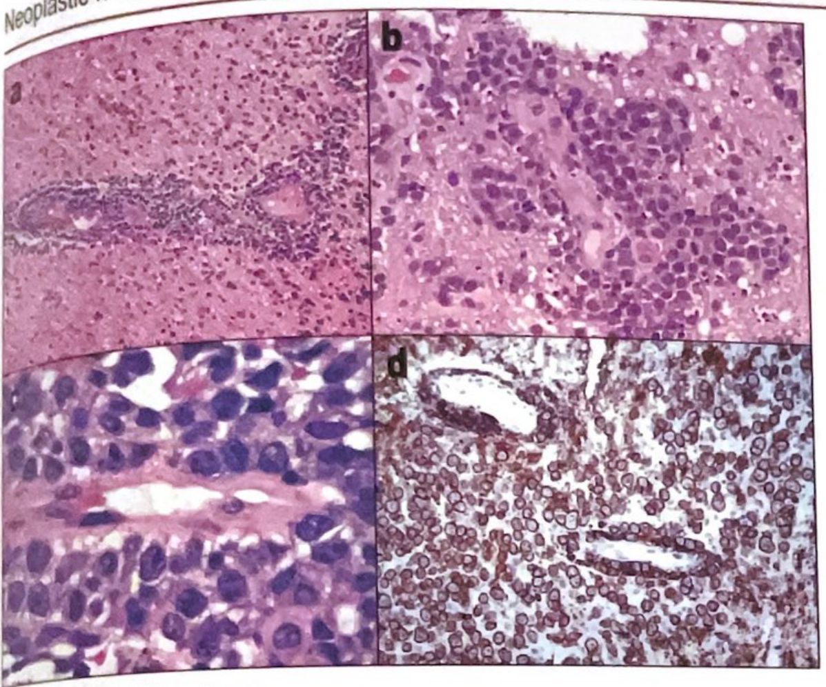 DLBCL - primary CNS lymphoma showing tight perivascular aggregates of large lymphocytes with strong CD20 expression (panel d)
