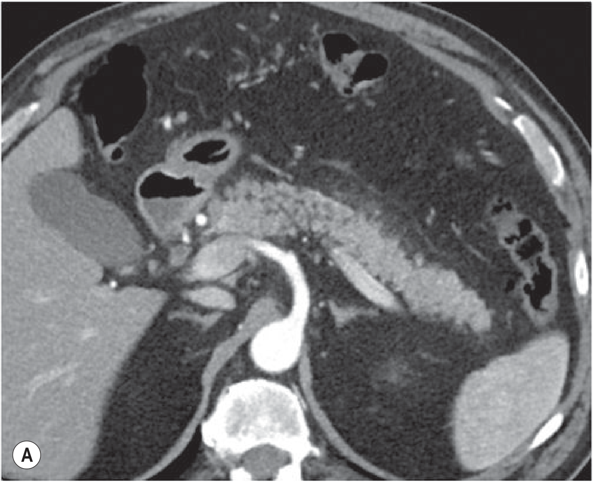 Fig 25.11A - Mild oedematous pancreatitis CT