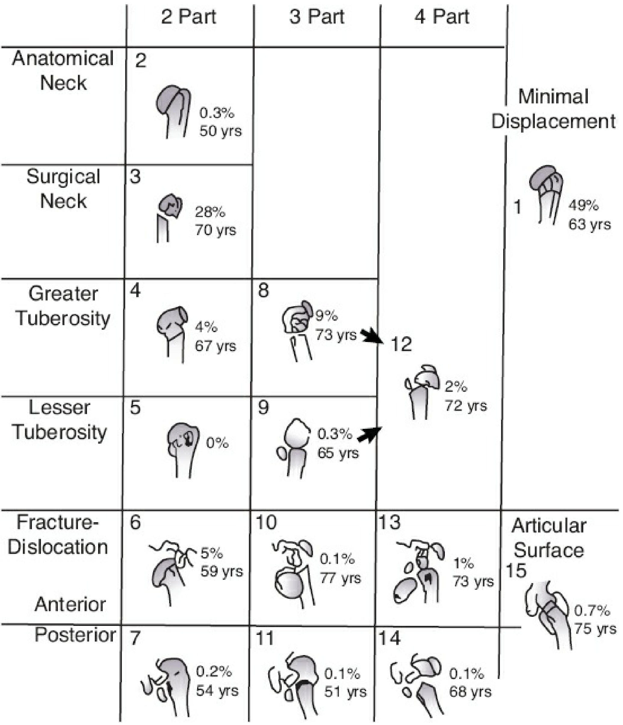 Neer Proximal Humerus Fracture Classification