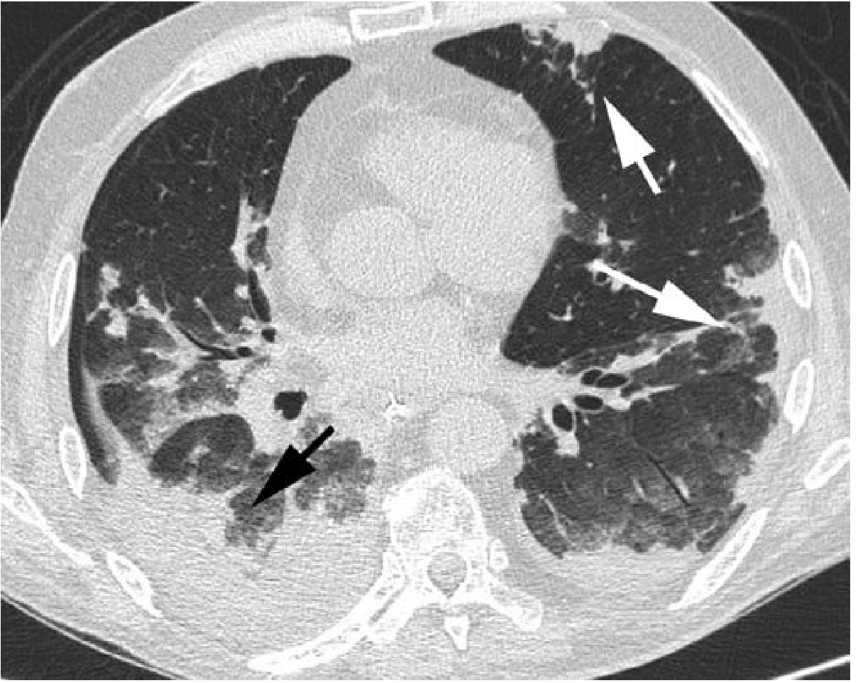 CT scan showing bilateral peripheral consolidations in bronchopneumonia - E. coli