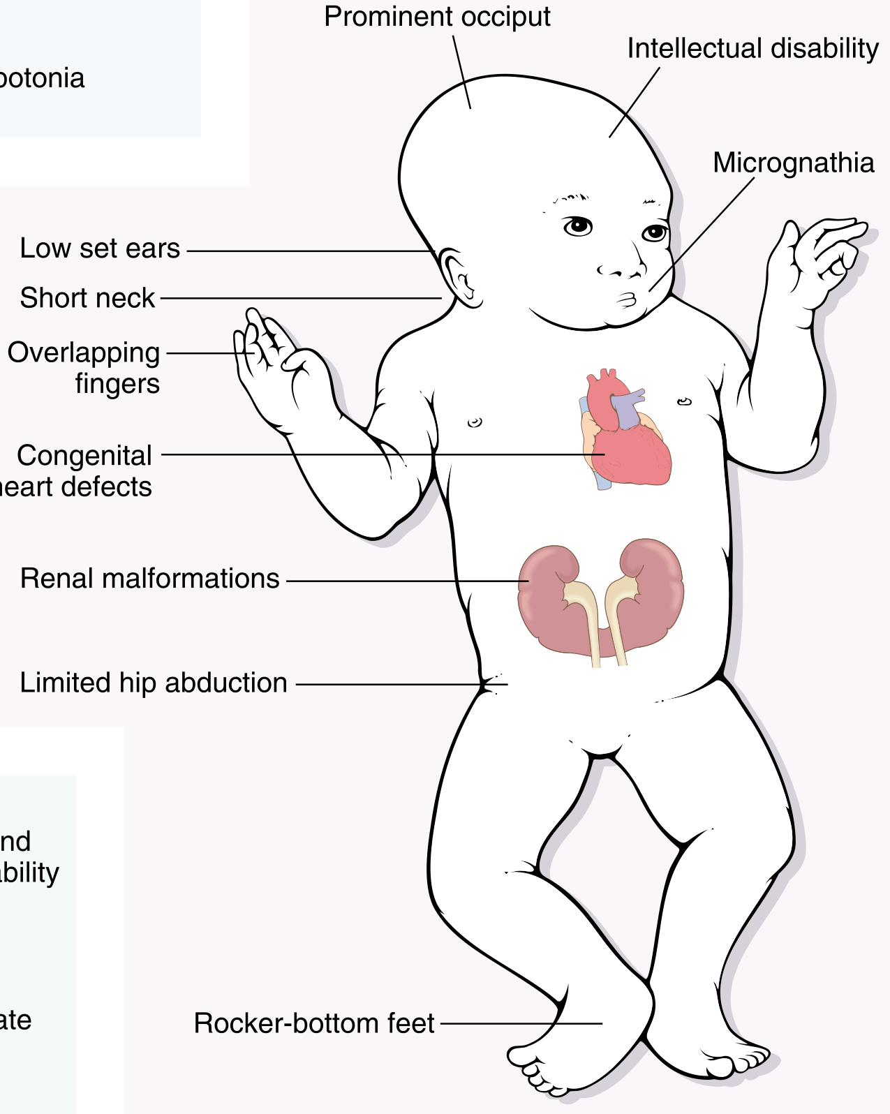 Down syndrome - Trisomy 21 clinical features diagram from Robbins