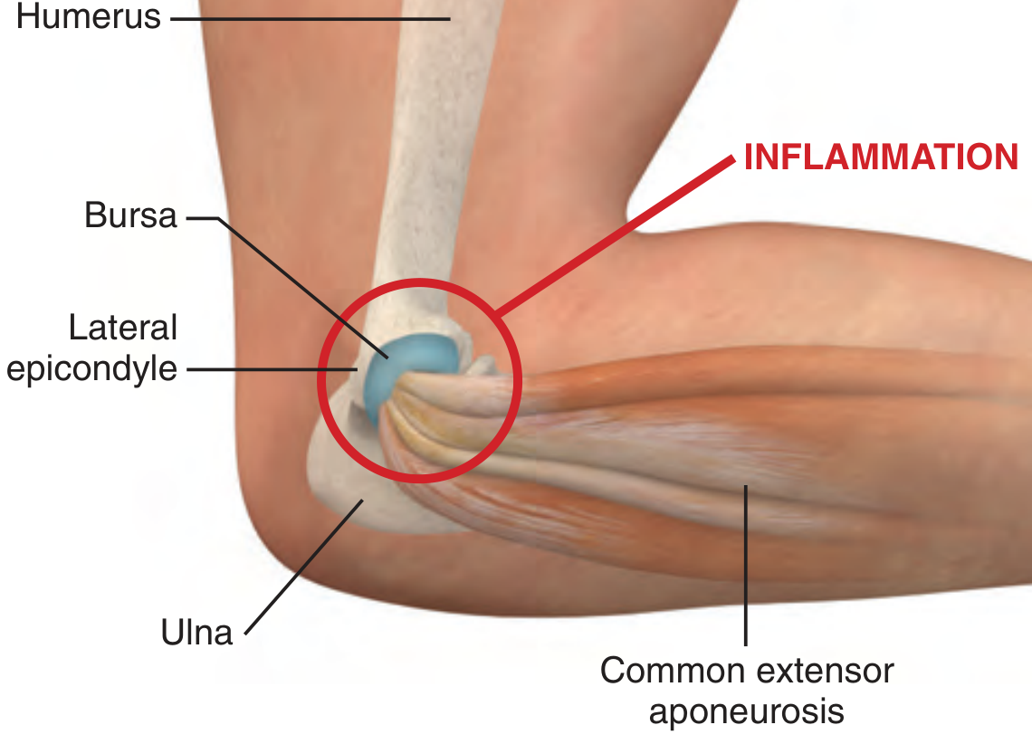 Lateral epicondylitis anatomy showing inflammation at the lateral epicondyle and common extensor aponeurosis