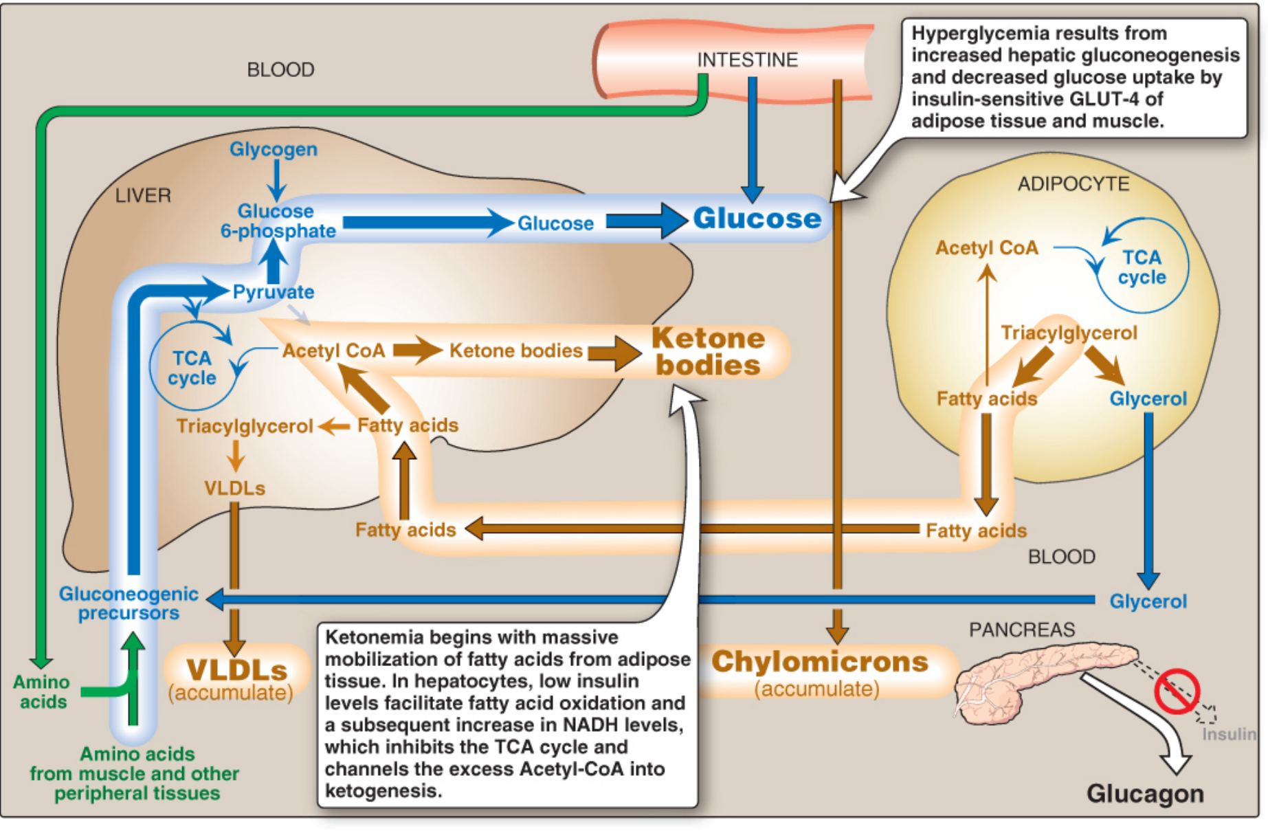 Type 1 Diabetes Metabolic Pathways - showing hyperglycemia from increased hepatic gluconeogenesis and ketone body production from fatty acid mobilization