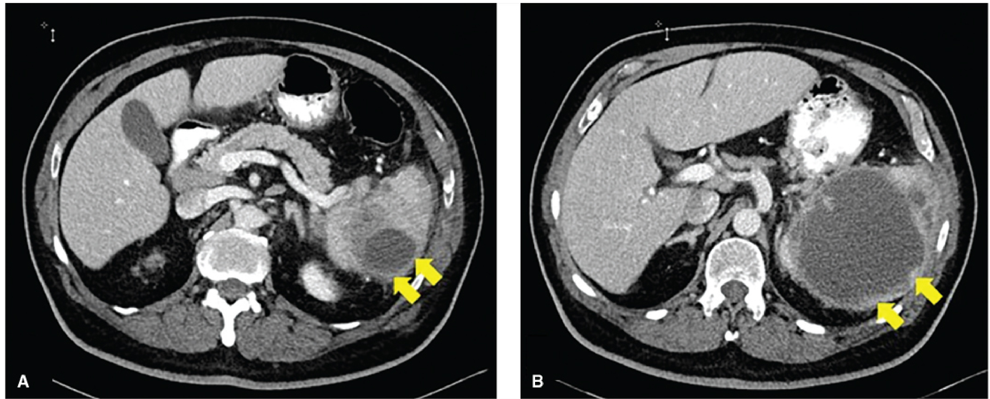 Axial CT scans showing splenic abscess (yellow arrows)