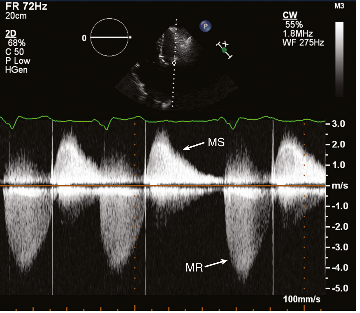 CW Doppler of severe MS with coexisting MR: above-the-line MS signal and below-the-line MR signal. Note the slow deceleration slope (prolonged PHT)
