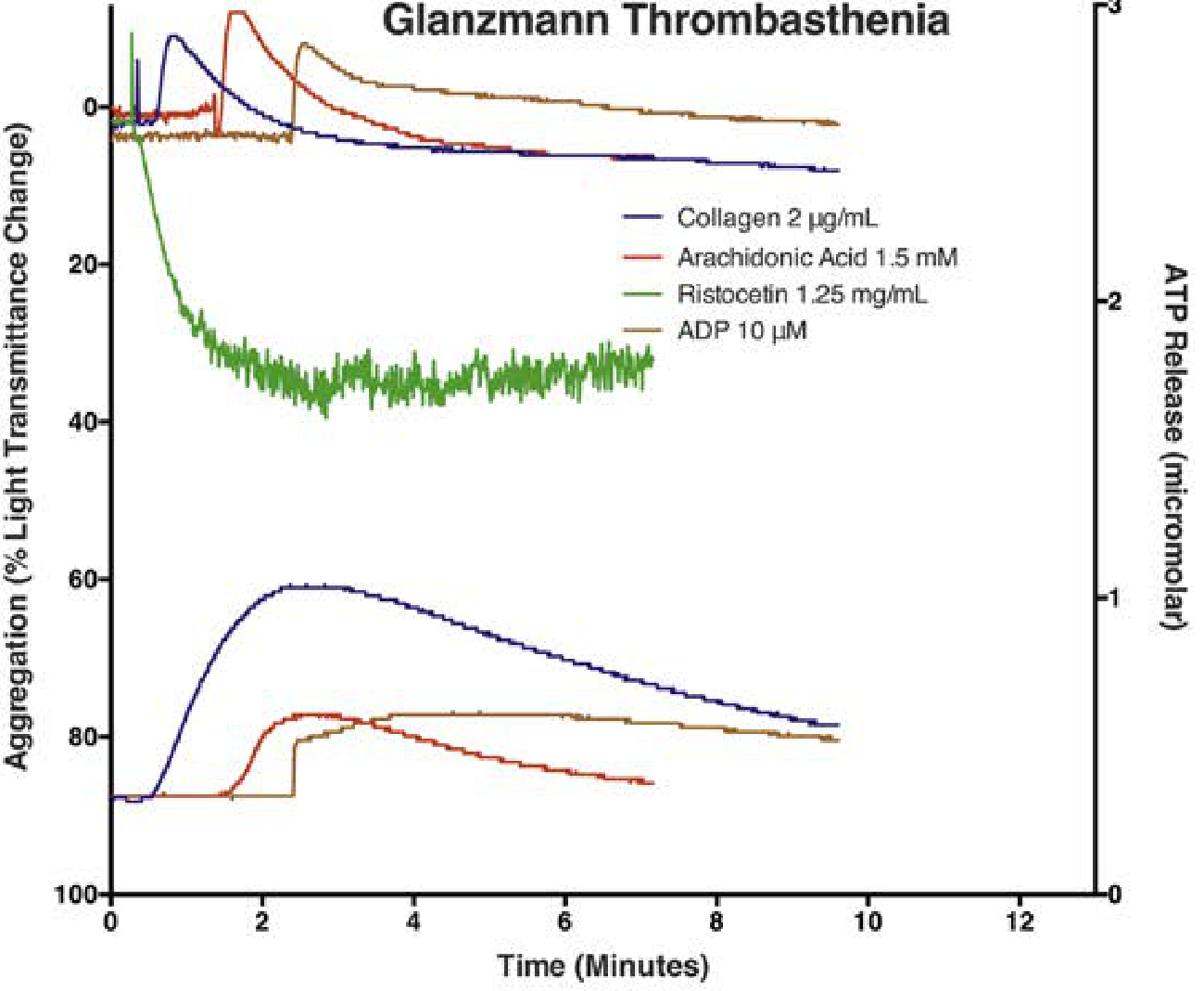 Glanzmann thrombasthenia platelet aggregometry tracing showing aggregation only with ristocetin, not with collagen, ADP, or arachidonic acid