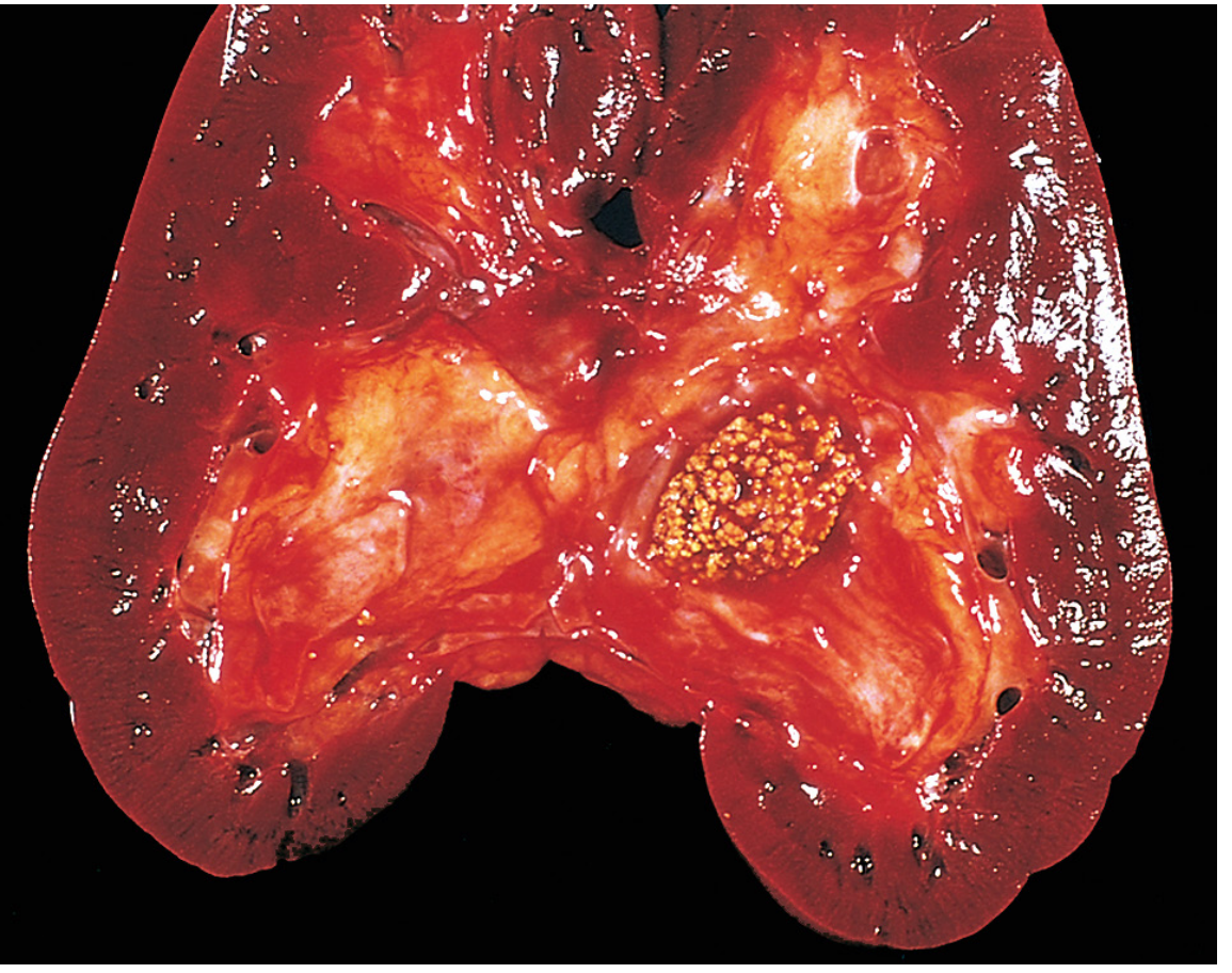 Gross pathology of urolithiasis - cross-section of kidney showing calculi in the pelvicalyceal system with surrounding tissue damage