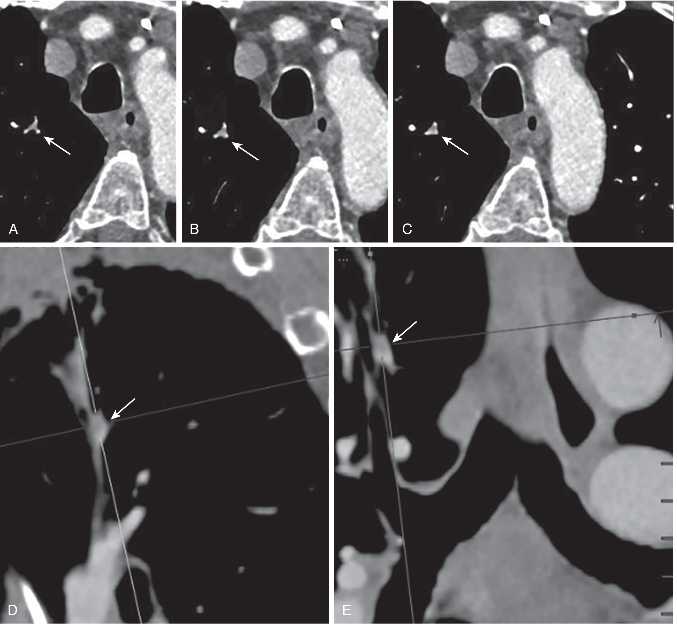 CTPA false positive overdiagnosis of PE