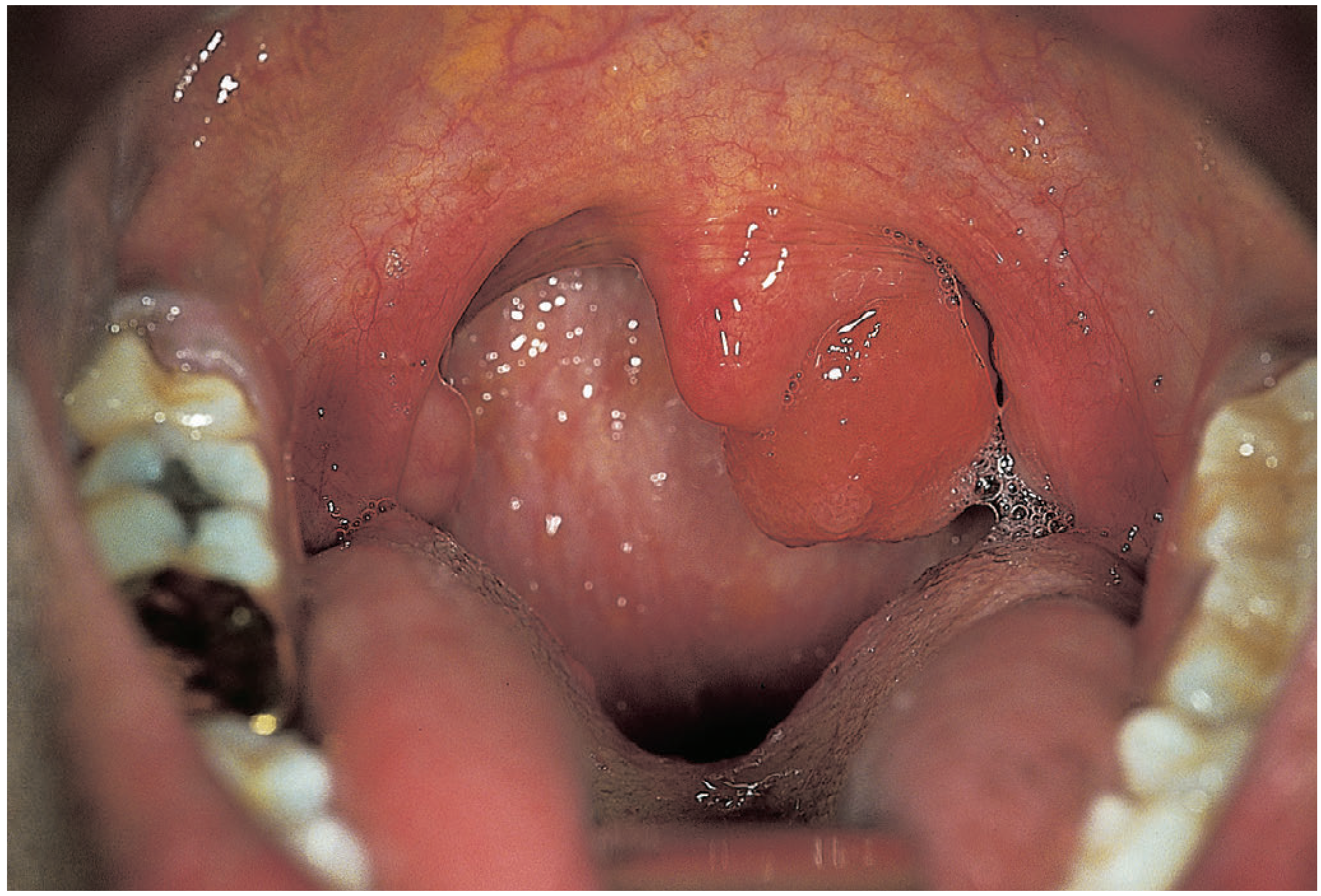 Intraoral view showing a large fleshy ACP polyp prolapsed into the oropharynx, hanging in the back of the mouth (Bailey & Love's, Fig. 52.22)