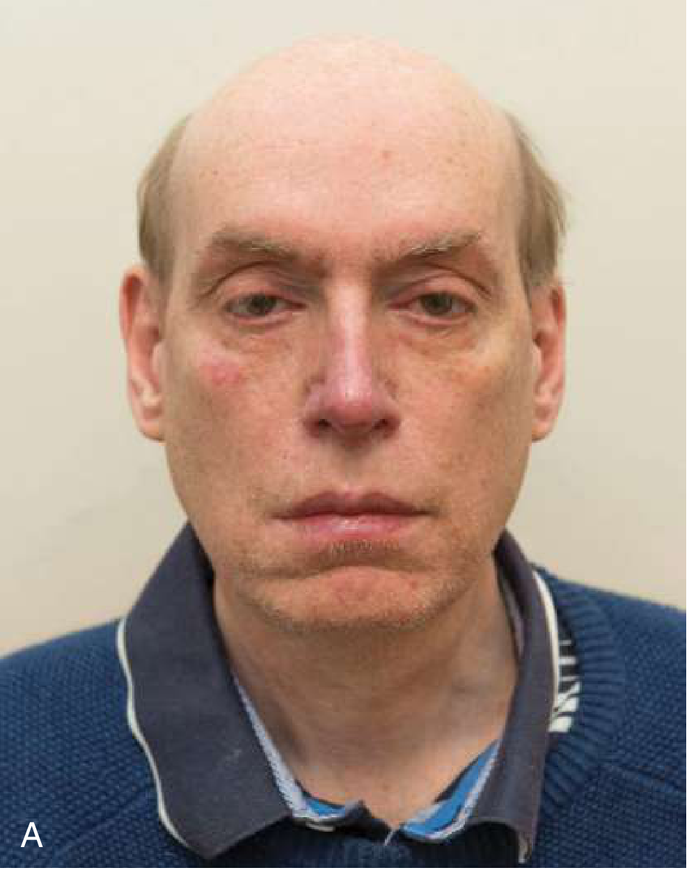 Myotonic dystrophy type 1 - frontal balding, ptosis, temporal atrophy (Panel A)