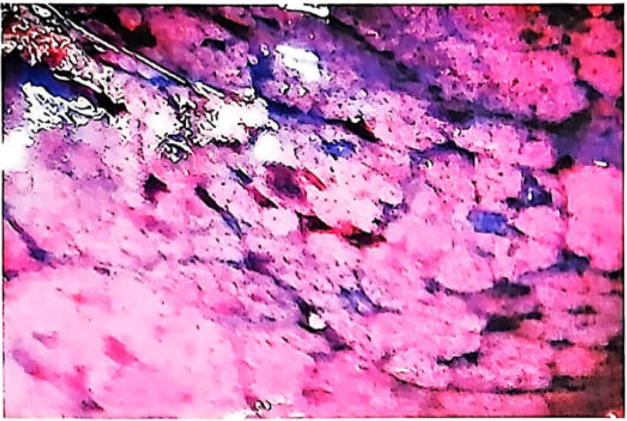 Tardieu spots on subpleural surface