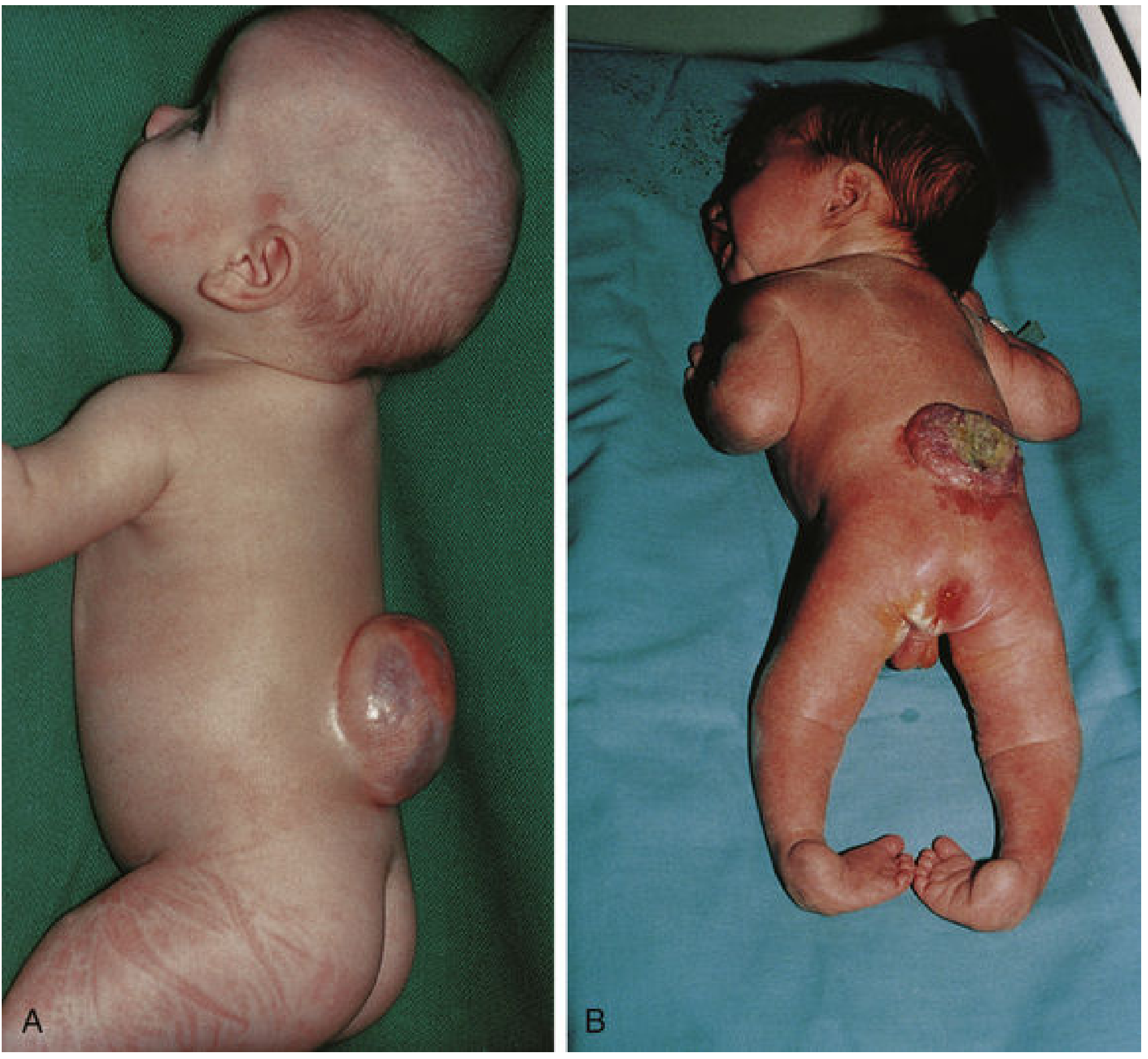 Clinical photo showing (A) infant with meningomyelocele as a smooth sac in the lumbar region, and (B) infant with myeloschisis showing exposed neural tissue and lower limb deformity