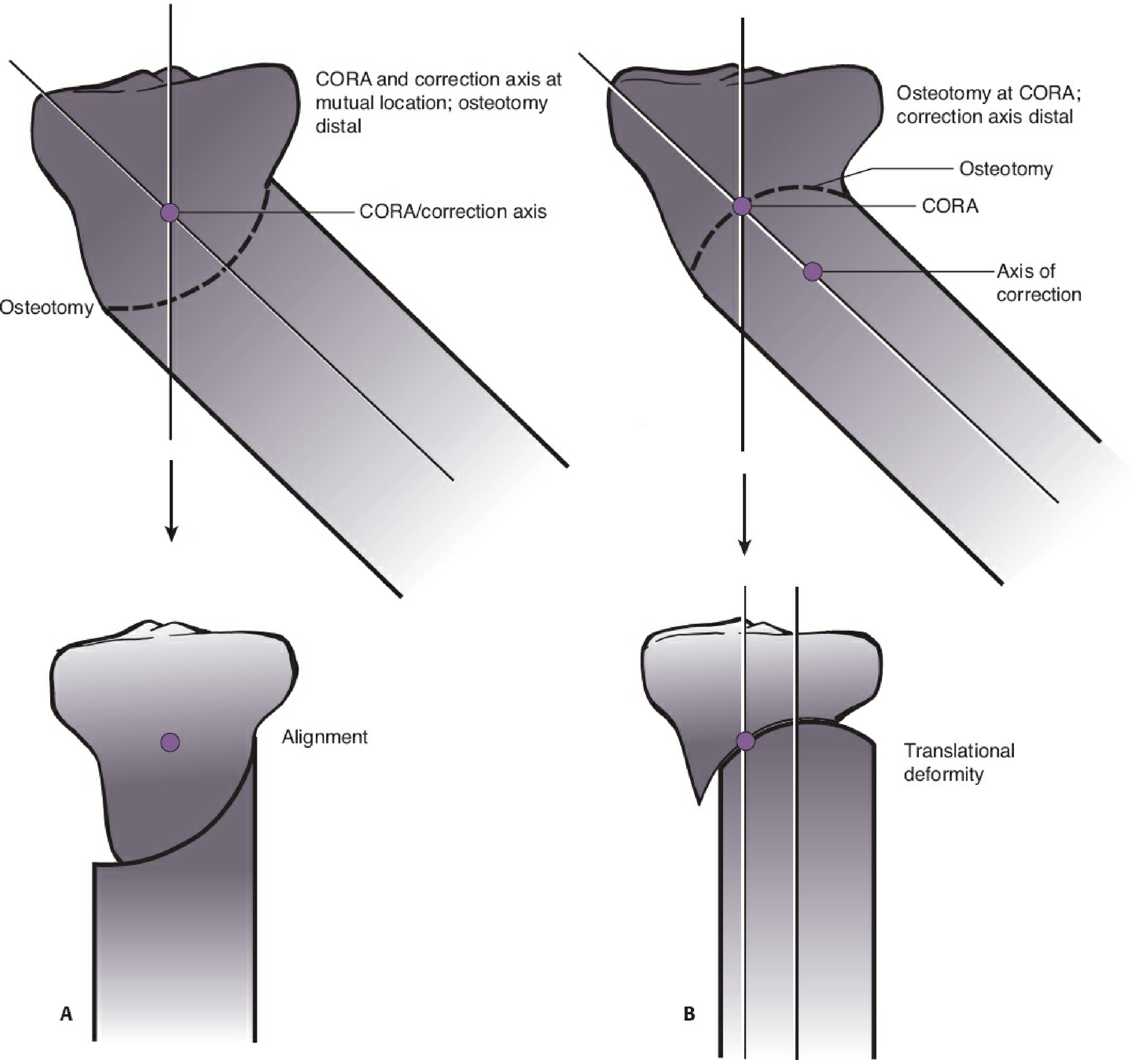 Dome osteotomy and CORA: A = CORA and correction axis at same location, osteotomy distal → alignment; B = CORA at osteotomy but correction axis distal → translational deformity
