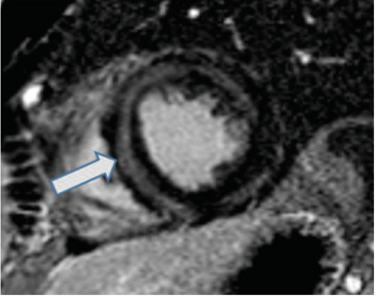 Cardiac MRI showing mid-wall late gadolinium enhancement (arrow) - the hallmark of myocarditis