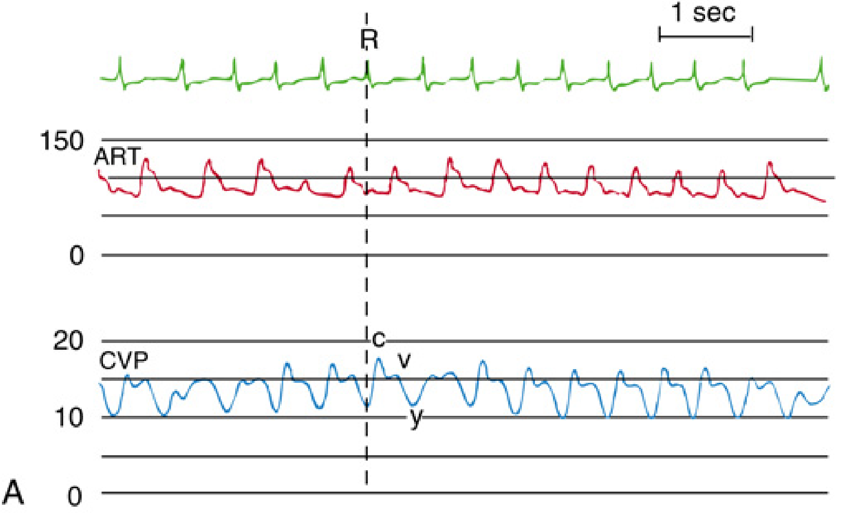 Tricuspid regurgitation CVP waveform showing tall c-v wave obliterating x descent