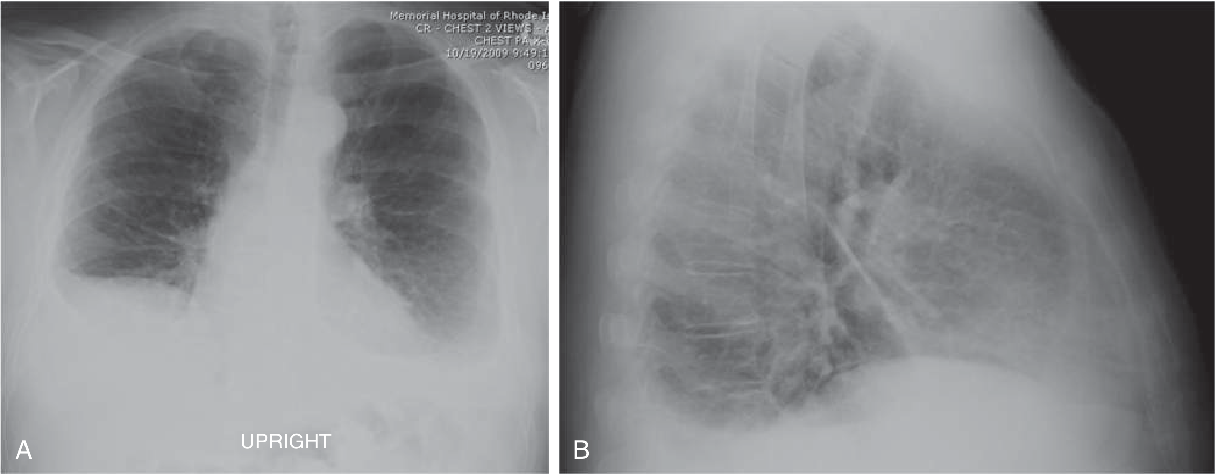 Bilateral pleural effusions on PA and lateral chest radiograph
