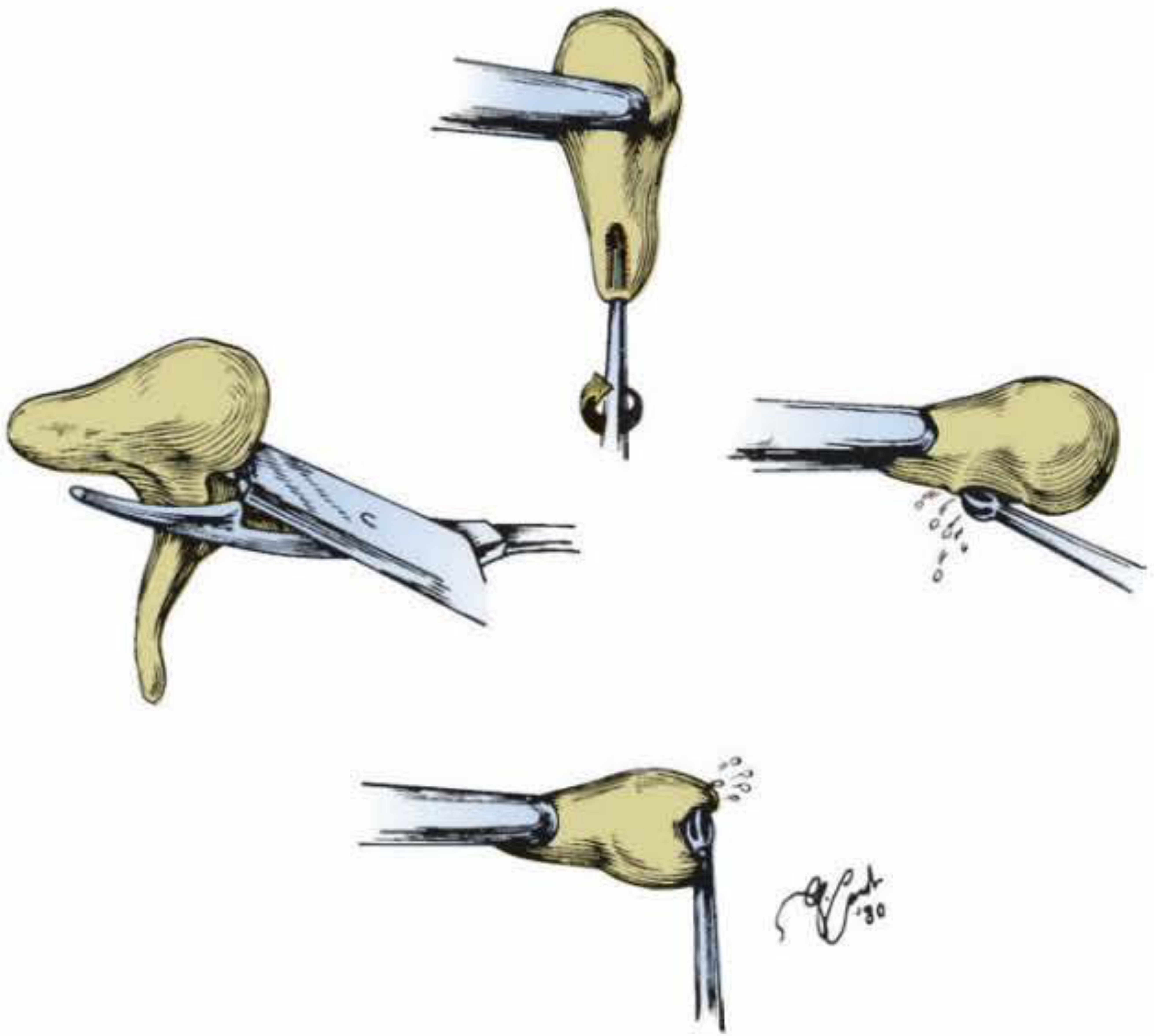 Fashioning a sculpted incus interposition graft - four steps showing groove creation and acetabulum drilling
