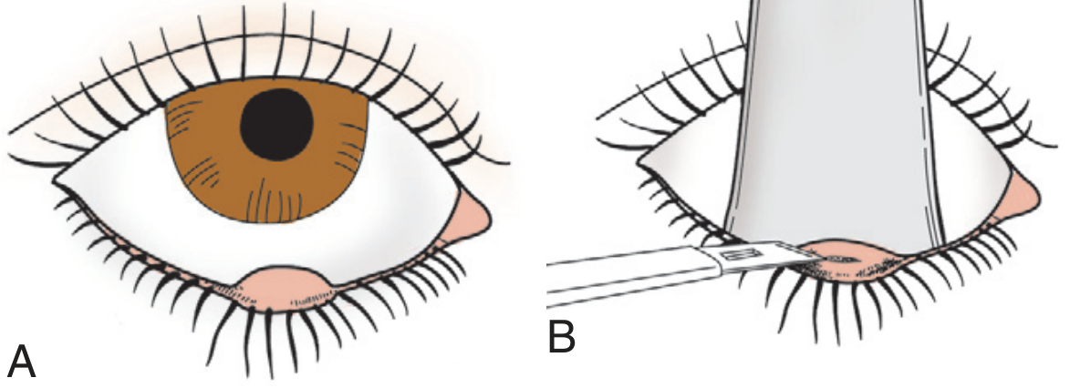 Textbook illustration: A - hordeolum pointing externally, B - incision and drainage with tongue blade protecting eye