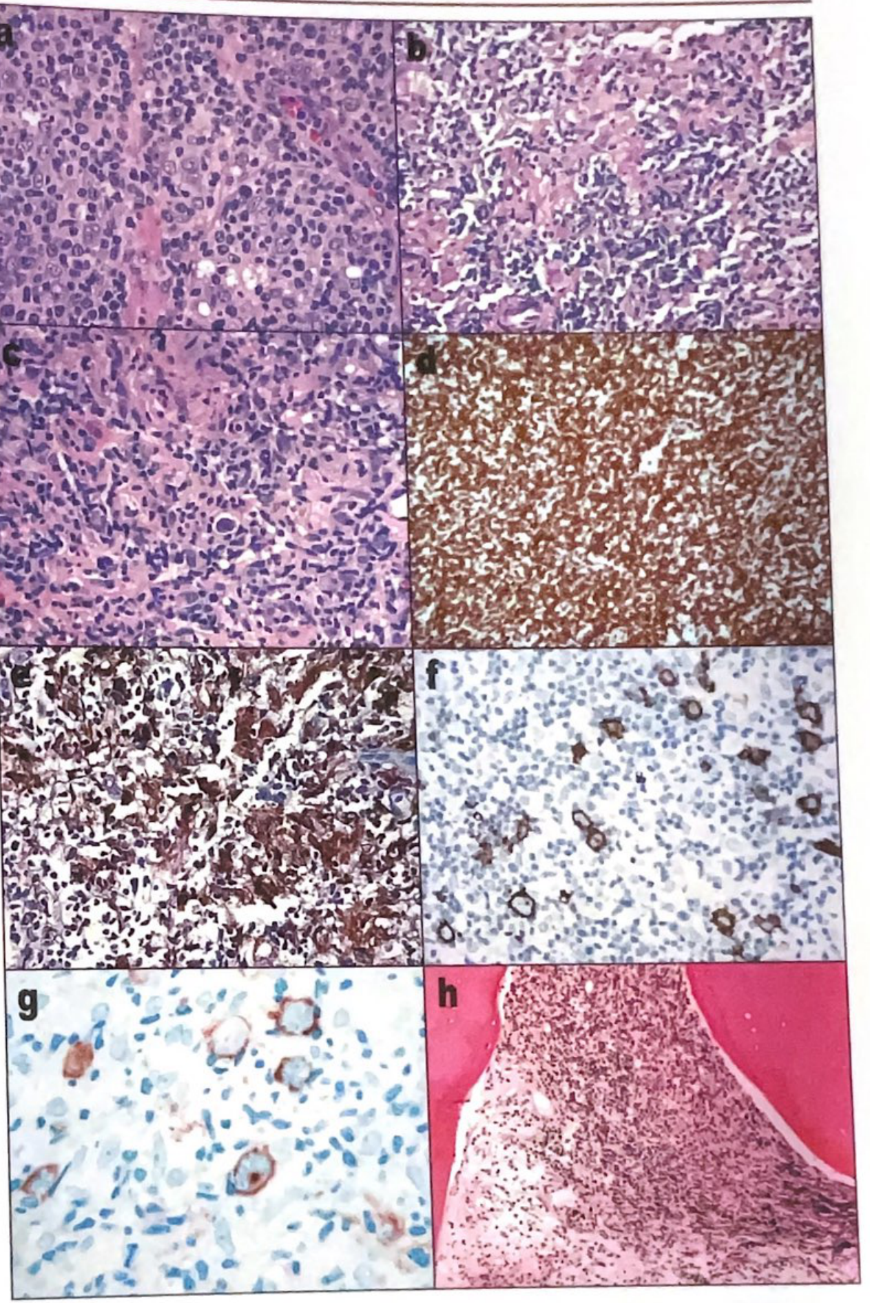 TCRBCL IHC panel showing CD3+ background T cells (panel d), CD68+ histiocytes (panel e), and CD20+/CD10+ large B cells (panels f,g)